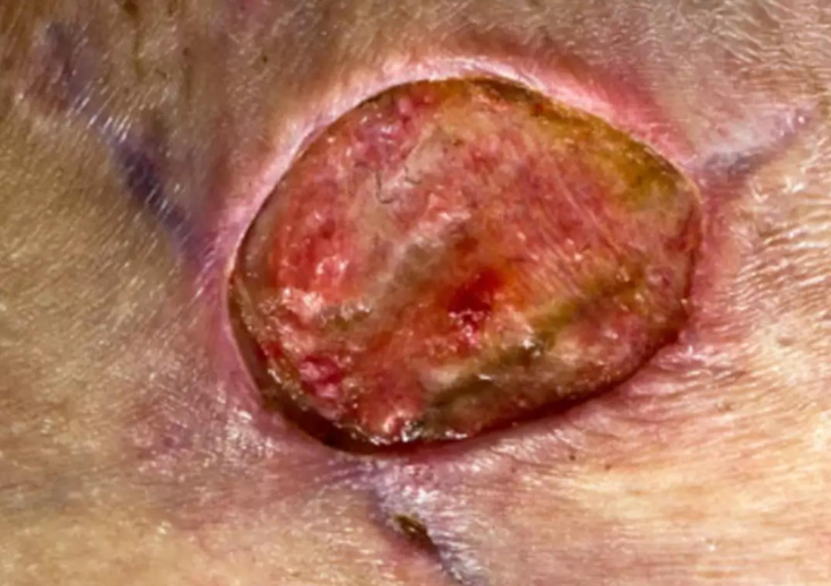 Σταφυλόκοκκος σε έξαρση το καλοκαίρι: Οι επιπλοκές οι κίνδυνοι που κρύβονται στην άμμο και πως να προστατευθούμε