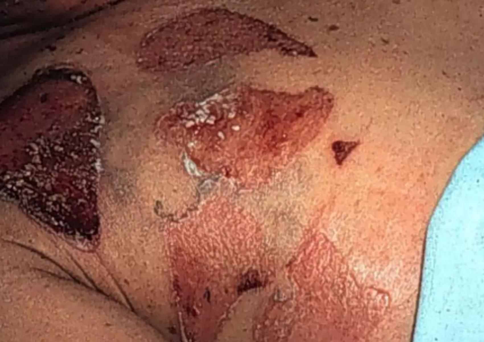 Σταφυλόκοκκος σε έξαρση το καλοκαίρι: Οι επιπλοκές οι κίνδυνοι που κρύβονται στην άμμο και πως να προστατευθούμε