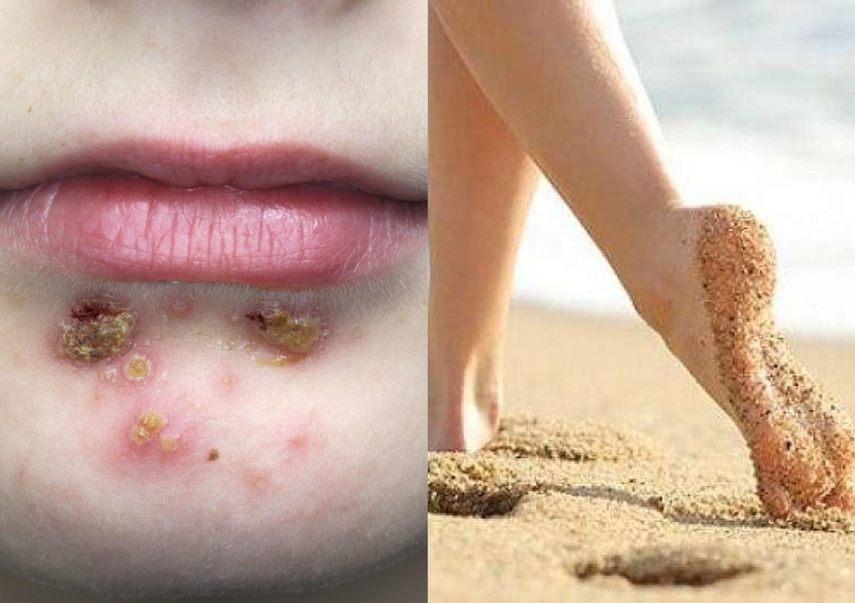 Σταφυλόκοκκος σε έξαρση το καλοκαίρι: Οι επιπλοκές οι κίνδυνοι που κρύβονται στην άμμο και πως να προστατευθούμε