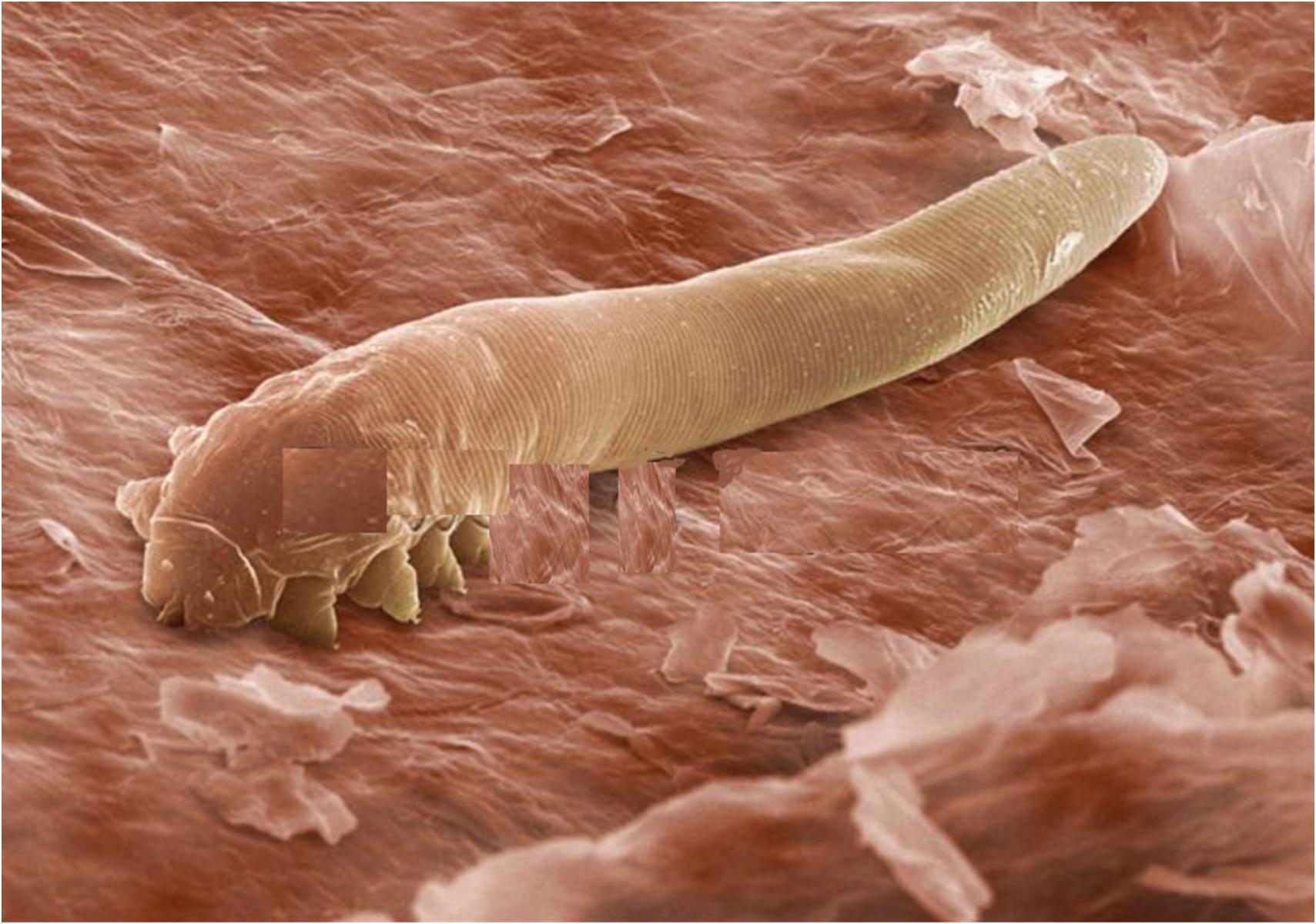 Demodex ή Δεμόδικας: Τα αόρατα αραχνοειδή ακάρεα που ζουν στο πρόσωπό μας και ποια προβλήματα υγείας προκαλούν
