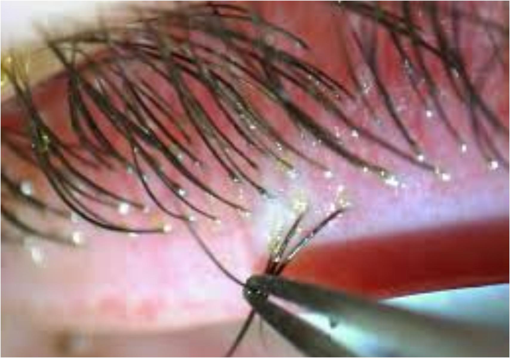 Demodex ή Δεμόδικας: Τα αόρατα αραχνοειδή ακάρεα που ζουν στο πρόσωπό μας και ποια προβλήματα υγείας προκαλούν