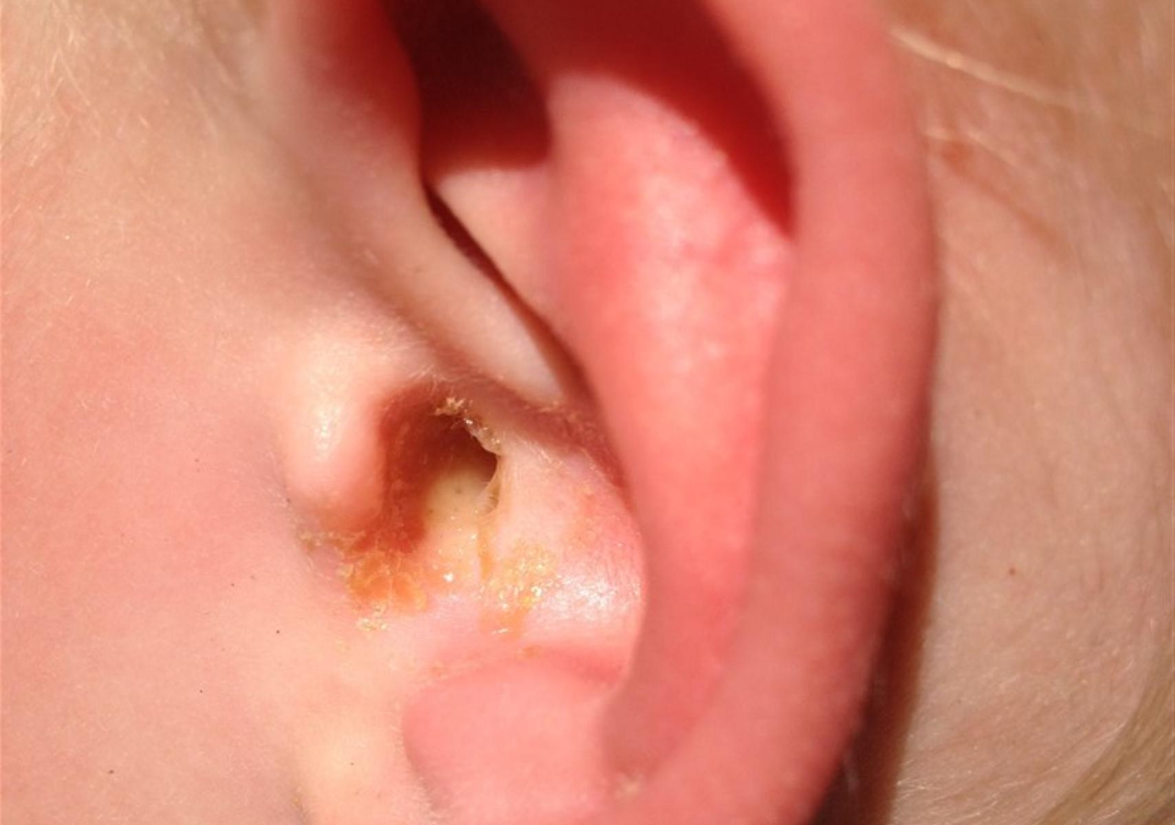 Το αυτί του κολυμβητή: Η πιο συχνή καλοκαιρινή πάθηση – Ποια είναι τα συμπτώματα ποια η θεραπεία και πως να προστατευθείτε