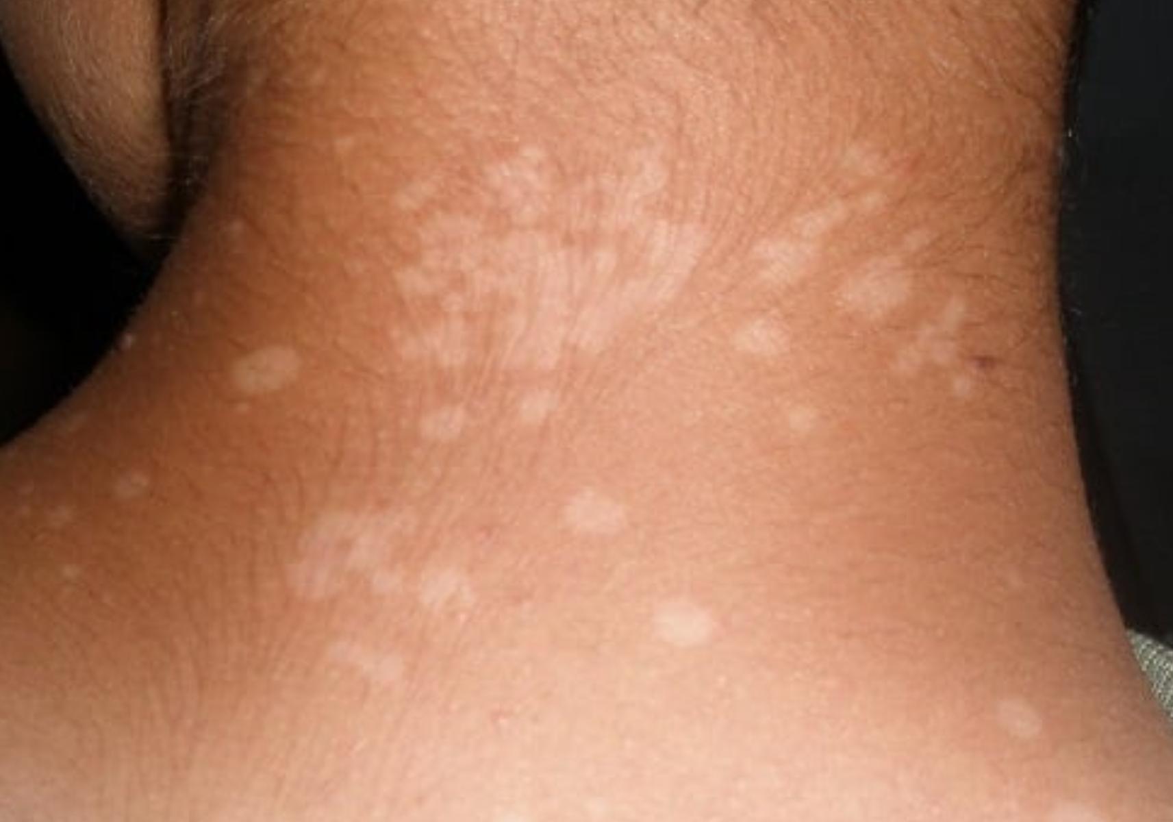 Ποικιλόχρους πιτυρίαση η ασθένεια του καλοκαιριού: Ποια τα αίτια ποια τα συμπτώματα και ποια η θεραπεία