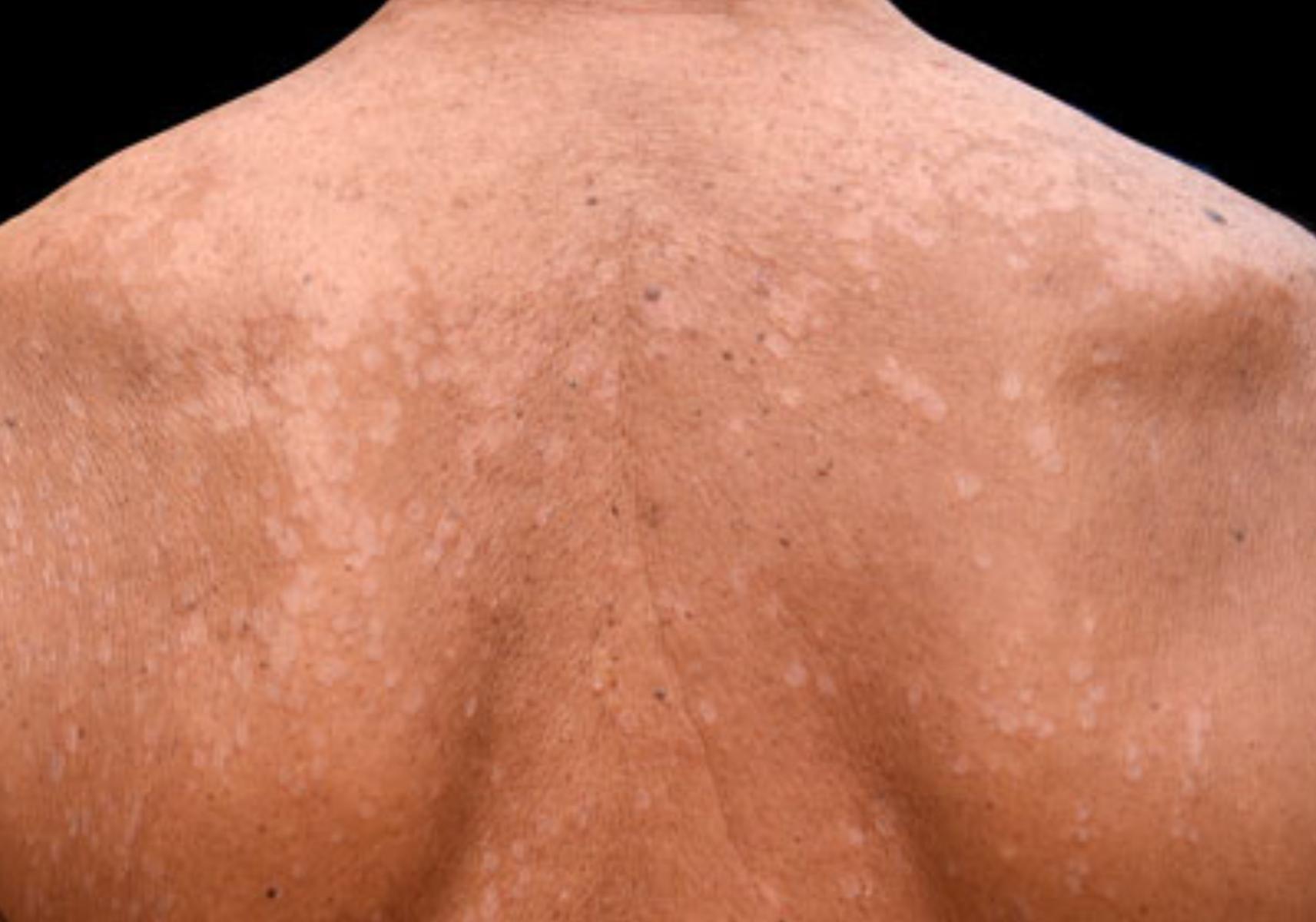 Ποικιλόχρους πιτυρίαση η ασθένεια του καλοκαιριού: Ποια τα αίτια ποια τα συμπτώματα και ποια η θεραπεία