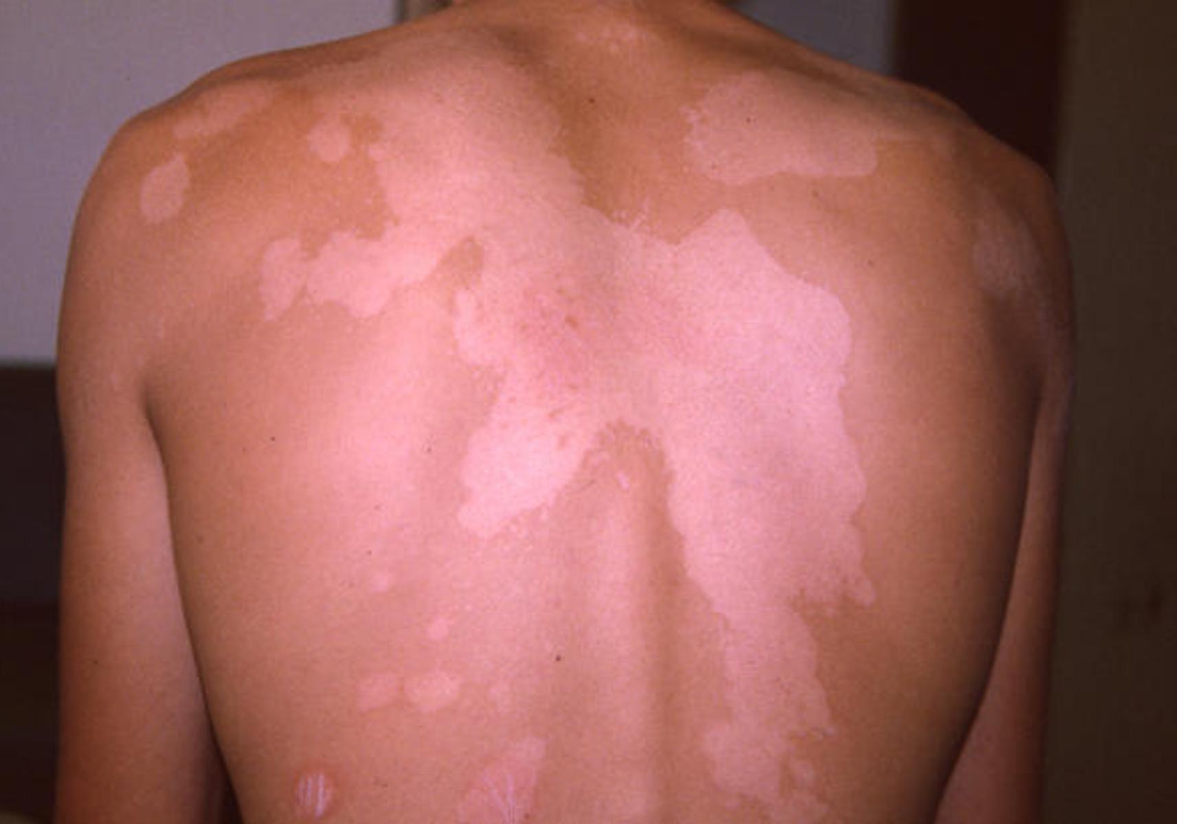 Ποικιλόχρους πιτυρίαση η ασθένεια του καλοκαιριού: Ποια τα αίτια ποια τα συμπτώματα και ποια η θεραπεία