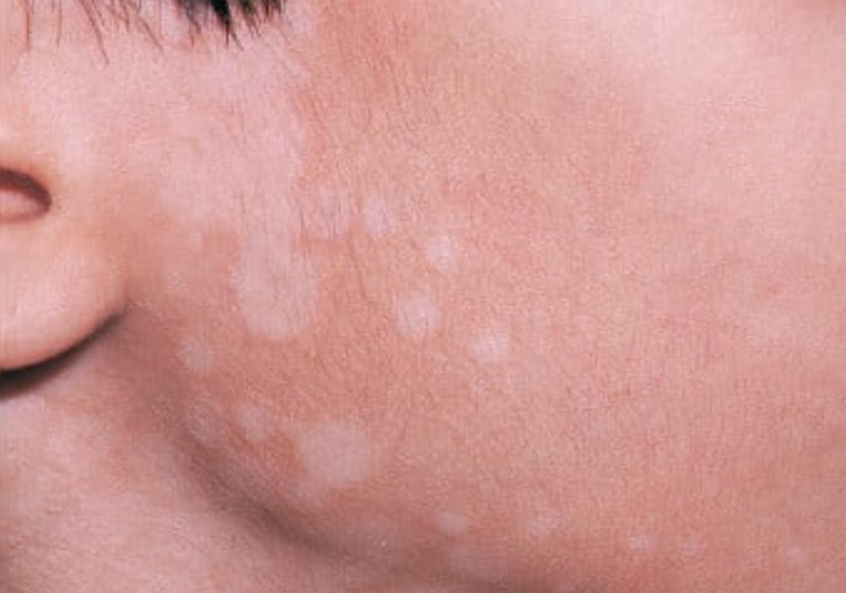 Ποικιλόχρους πιτυρίαση η ασθένεια του καλοκαιριού: Ποια τα αίτια ποια τα συμπτώματα και ποια η θεραπεία