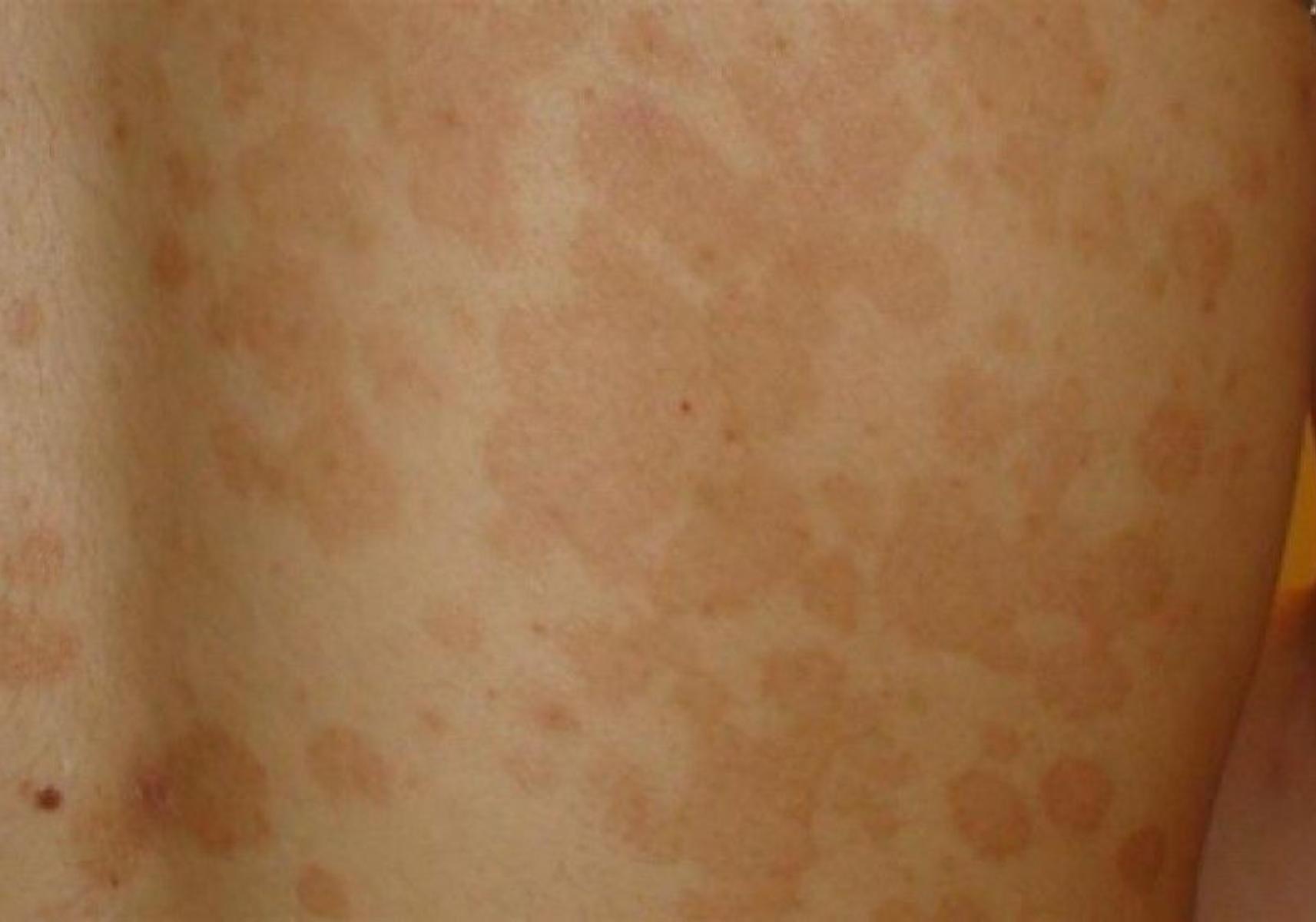 Ποικιλόχρους πιτυρίαση η ασθένεια του καλοκαιριού: Ποια τα αίτια ποια τα συμπτώματα και ποια η θεραπεία