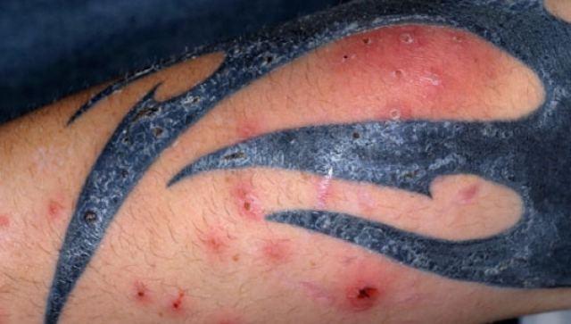 Γιατί απαγορεύεται να κάνετε τατουάζ το Καλοκαίρι και πως να το προστατεύσετε αν έχετε ήδη Γιατί απαγορεύεται να κάνετε τατουάζ το Καλοκαίρι και πως να το προστατεύσετε αν έχετε ήδη