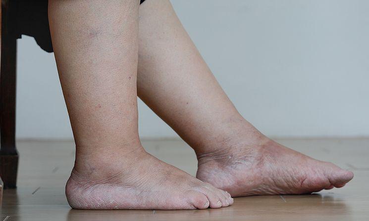Πρησμένα πόδια το Καλοκαίρι: Γιατί συμβαίνει και πως το αντιμετωπίζουμε
