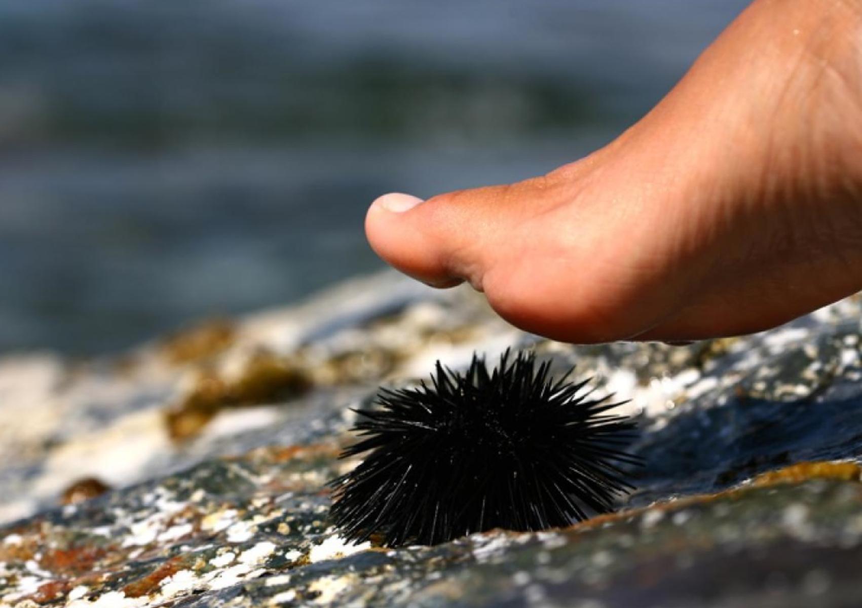 Αχινός: Τι πρέπει και τι δεν πρέπει να κάνετε με τίποτα αν τον πατήσετε 