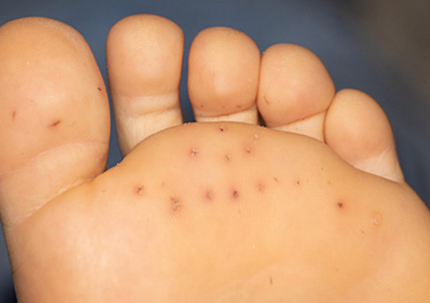 Αχινός: Τι πρέπει και τι δεν πρέπει να κάνετε με τίποτα αν τον πατήσετε