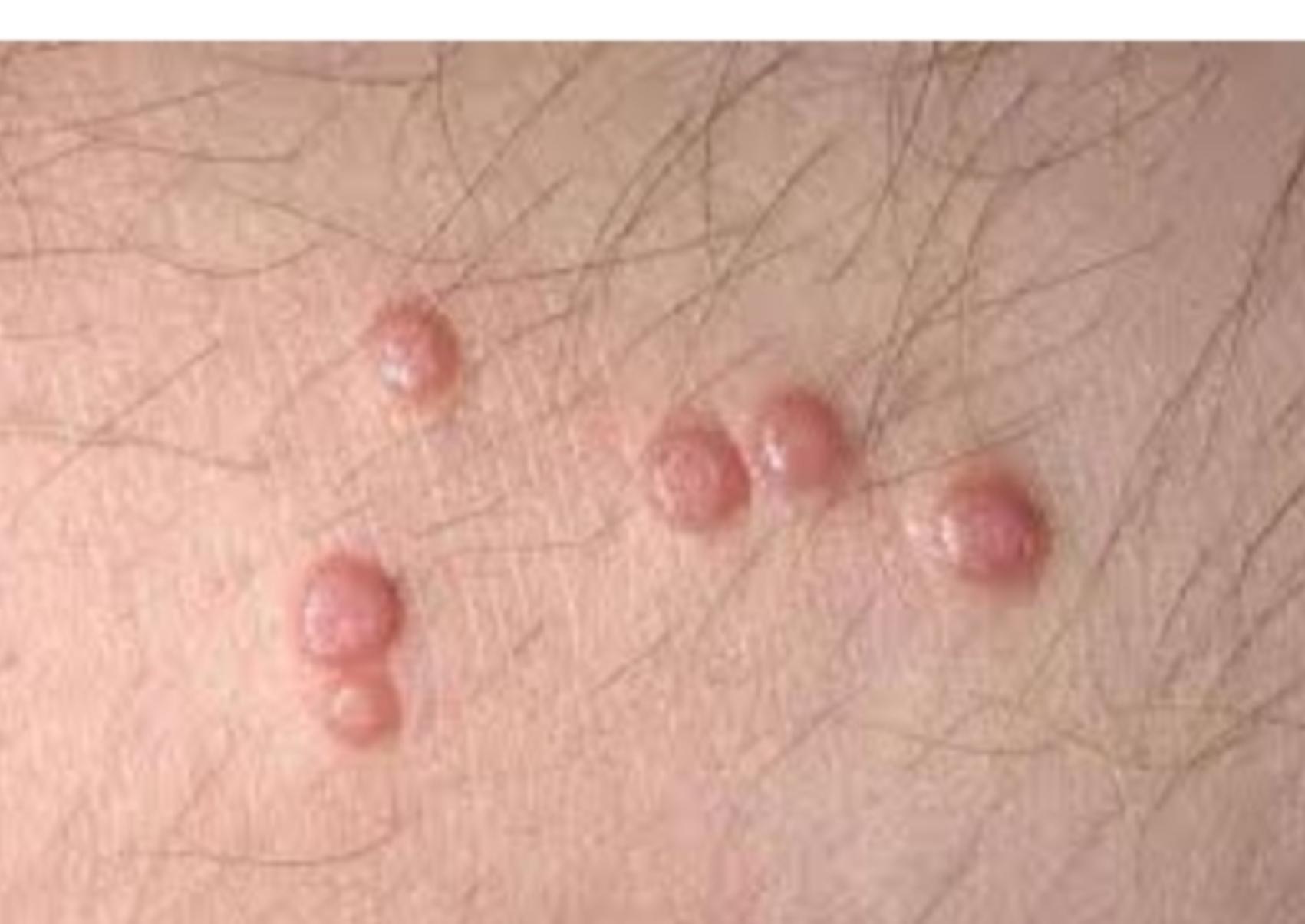 Μυρμηγκιές: Τι είναι ποια τα συμπτώματα και ποια η θεραπεία ενός από τους πιο συχνούς ιούς του καλοκαιριού