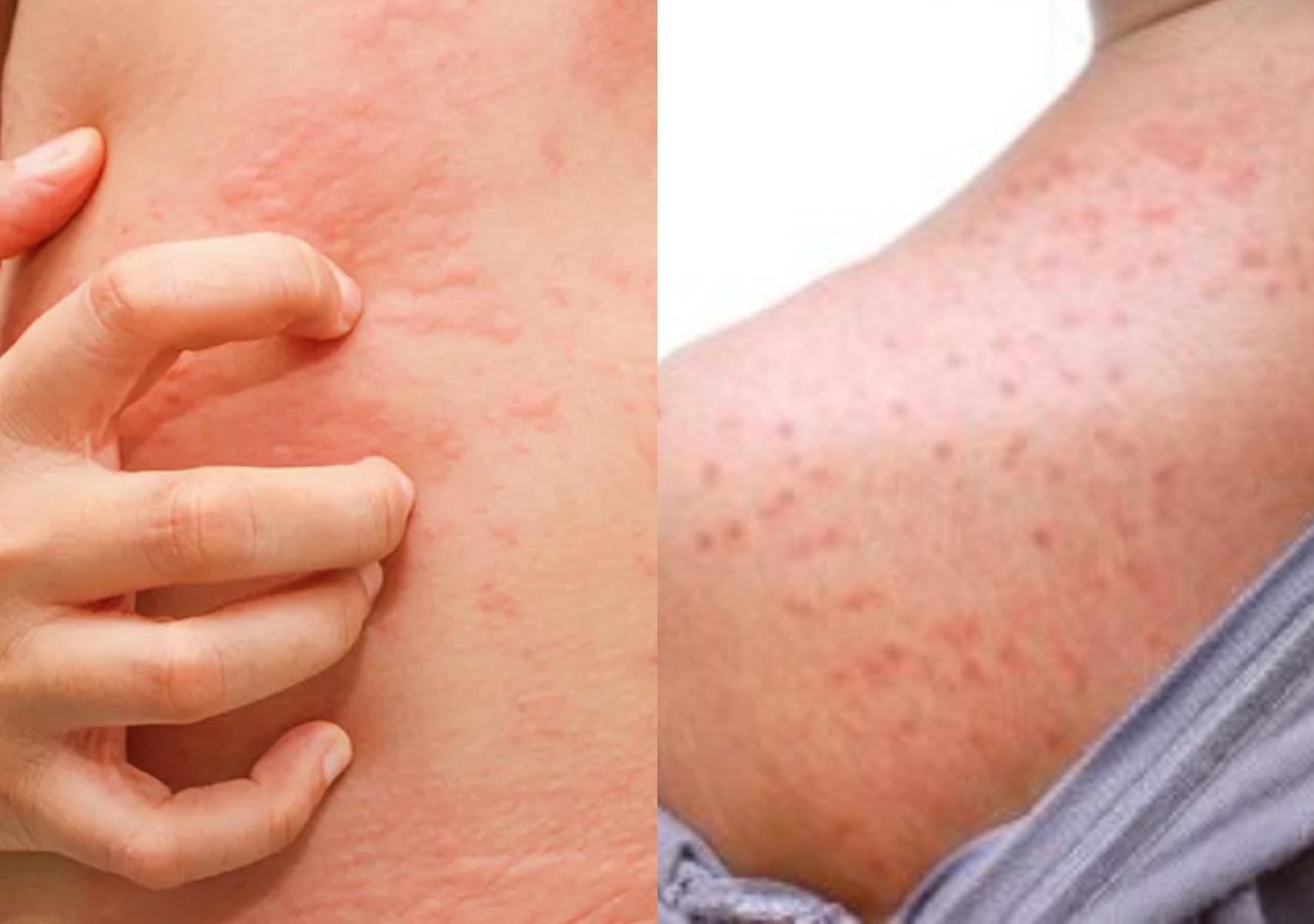 Θερμικό εξάνθημα: Τι είναι ποια τα συμπτώματα και πως να αντιμετωπίσετε την πιο συχνή δερματική πάθηση του καλοκαιριού