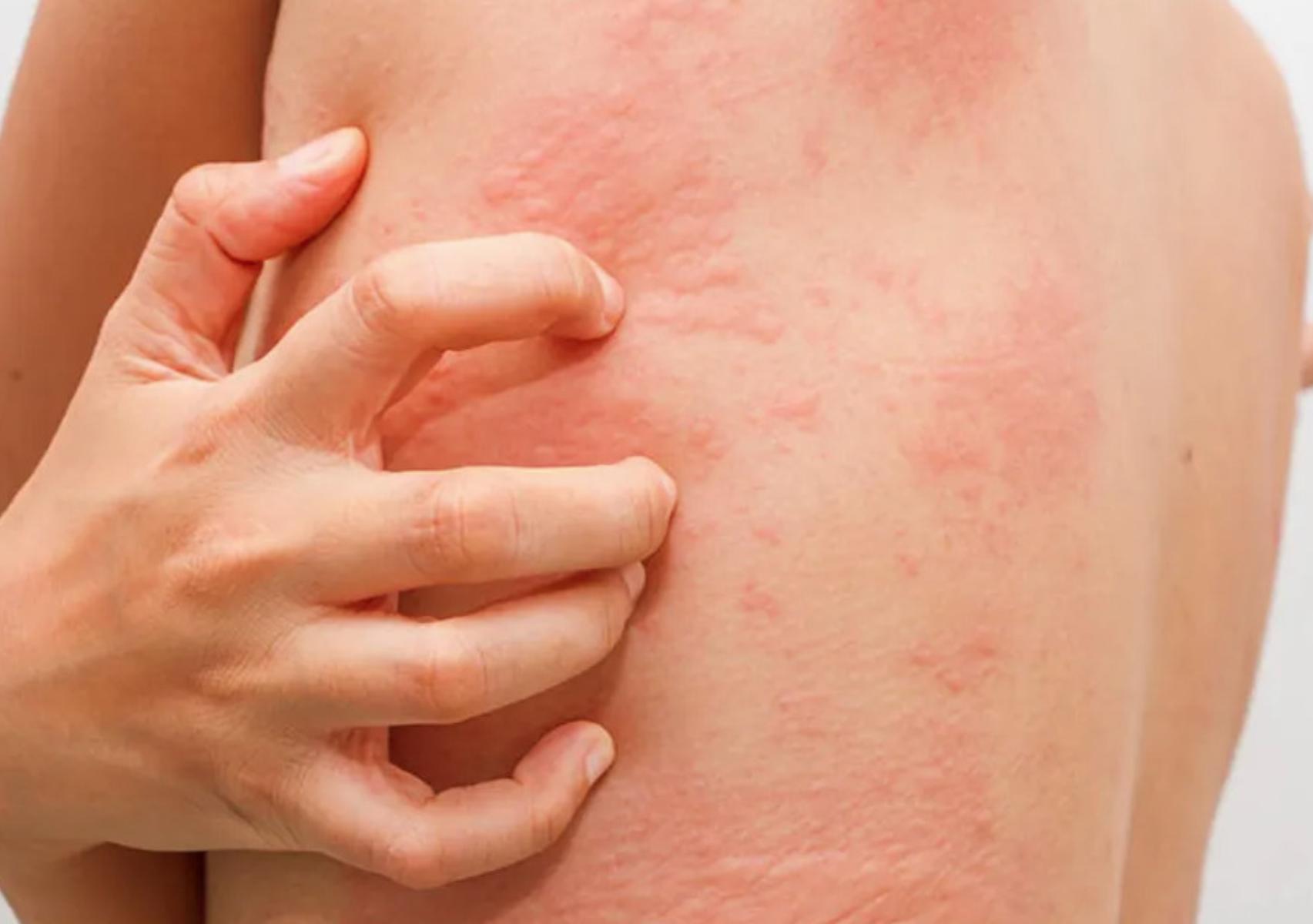 Θερμικό εξάνθημα: Τι είναι ποια τα συμπτώματα και πως να αντιμετωπίσετε την πιο συχνή δερματική πάθηση του καλοκαιριού