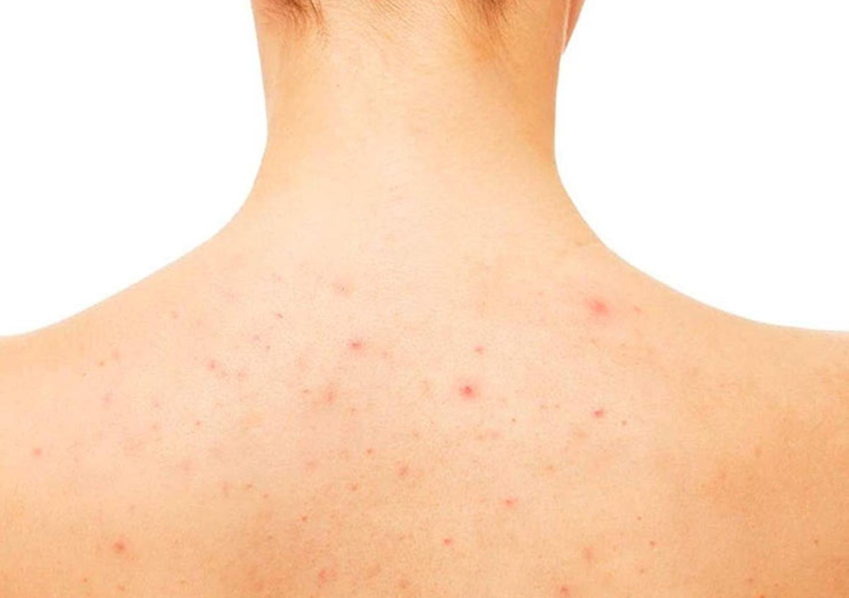 Θερμικό εξάνθημα: Τι είναι ποια τα συμπτώματα και πως να αντιμετωπίσετε την πιο συχνή δερματική πάθηση του καλοκαιριού