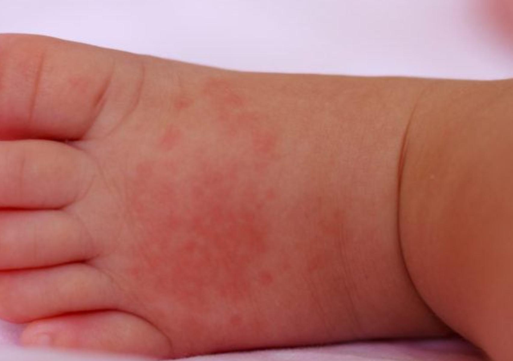 Θερμικό εξάνθημα: Τι είναι ποια τα συμπτώματα και πως να αντιμετωπίσετε την πιο συχνή δερματική πάθηση του καλοκαιριού