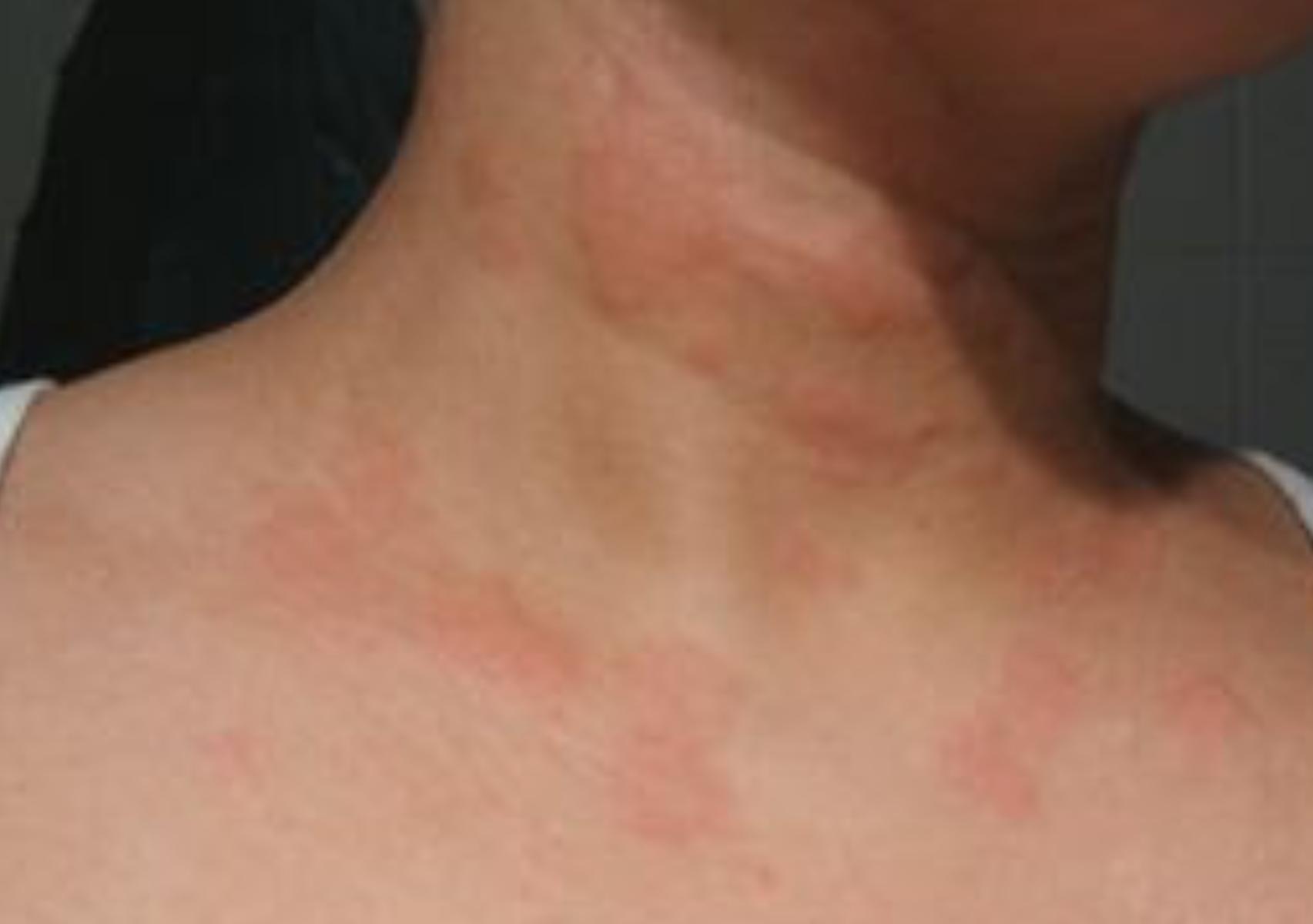 Θερμικό εξάνθημα: Τι είναι ποια τα συμπτώματα και πως να αντιμετωπίσετε την πιο συχνή δερματική πάθηση του καλοκαιριού