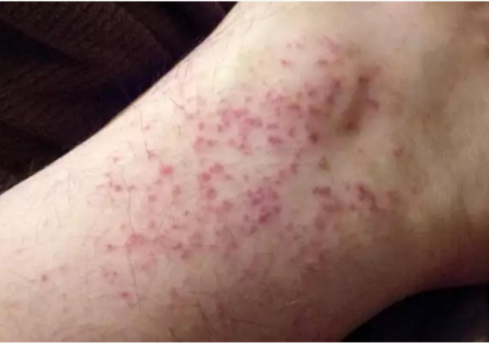 Miliaria Rubra: Τα εξανθήματα του ιδρώτα- Συμπτώματα και θεραπεία