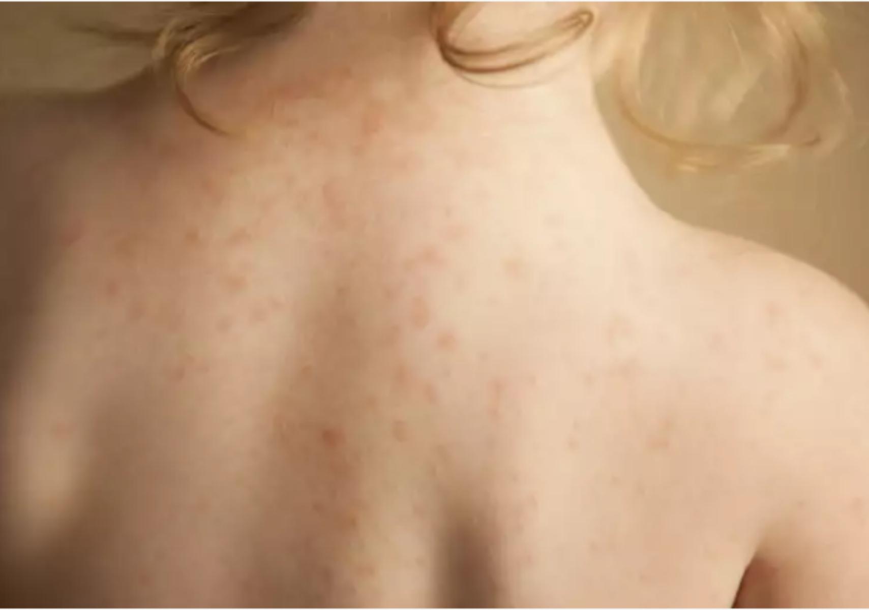 Miliaria Rubra: Τα εξανθήματα του ιδρώτα- Συμπτώματα και θεραπεία