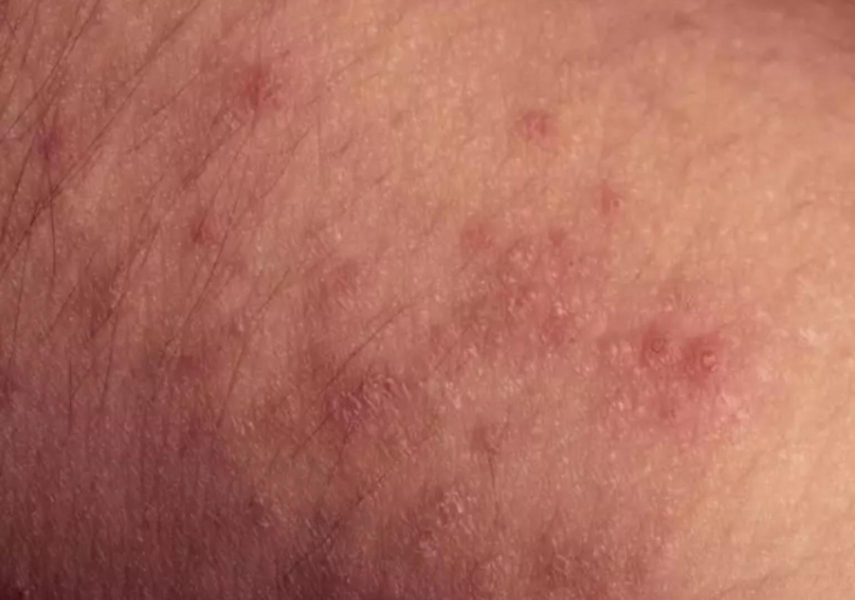 Miliaria Rubra: Τα εξανθήματα του ιδρώτα- Συμπτώματα και θεραπεία