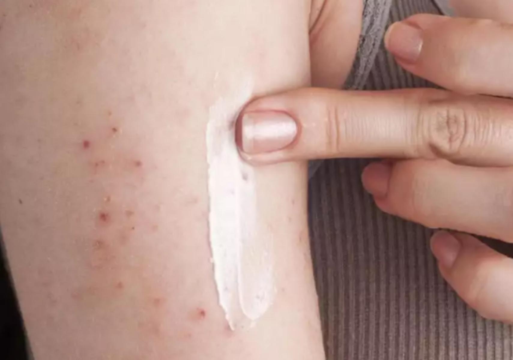 Miliaria Rubra: Τα εξανθήματα του ιδρώτα- Συμπτώματα και θεραπεία