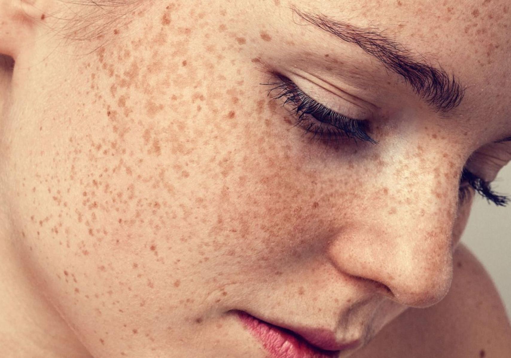 Πανάδες ή Κηλίδες από τον ήλιο: Γιατί εμφανίζονται και πώς θα τις αντιμετωπίσετε