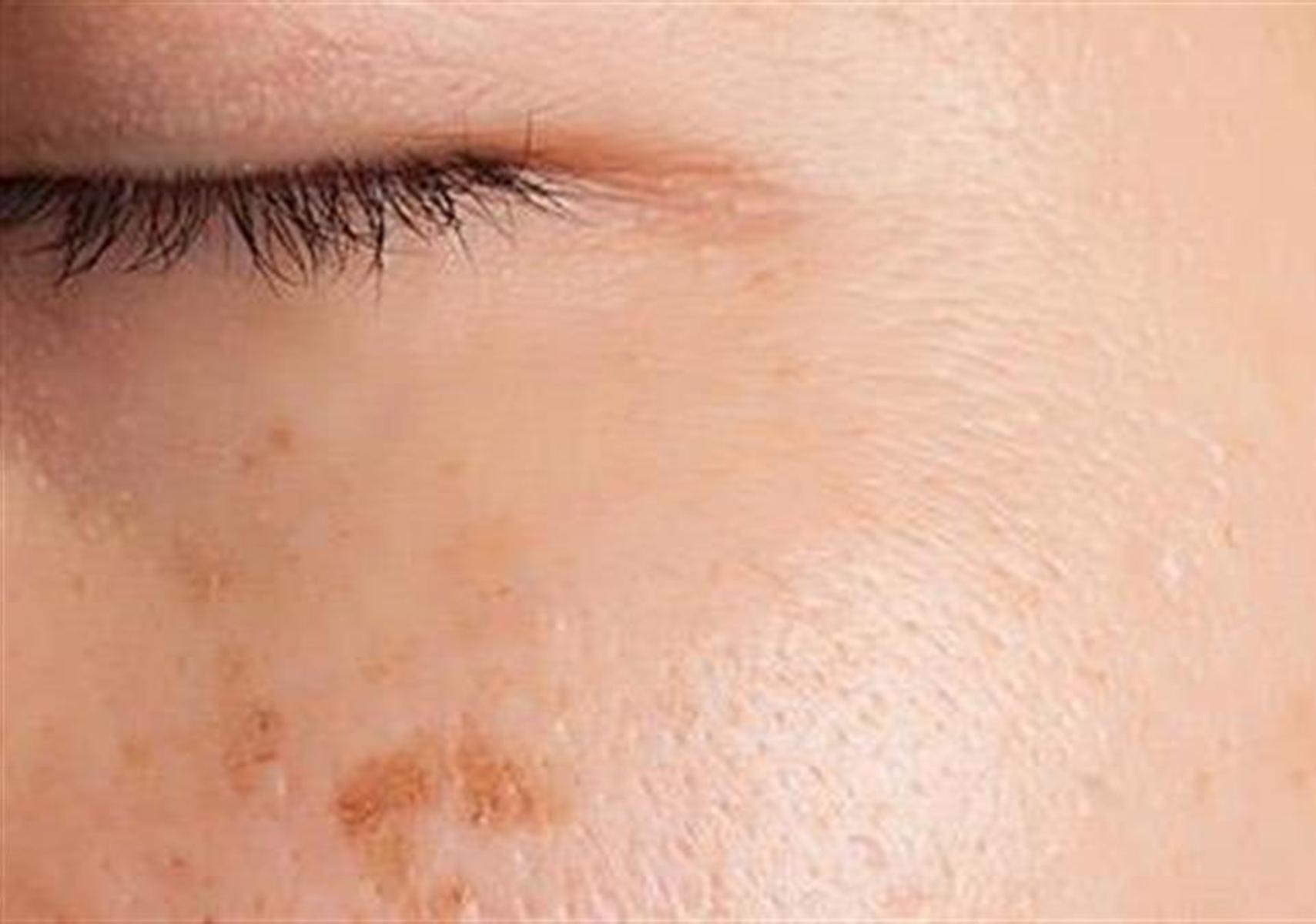 Πανάδες ή Κηλίδες από τον ήλιο: Γιατί εμφανίζονται και πώς θα τις αντιμετωπίσετε