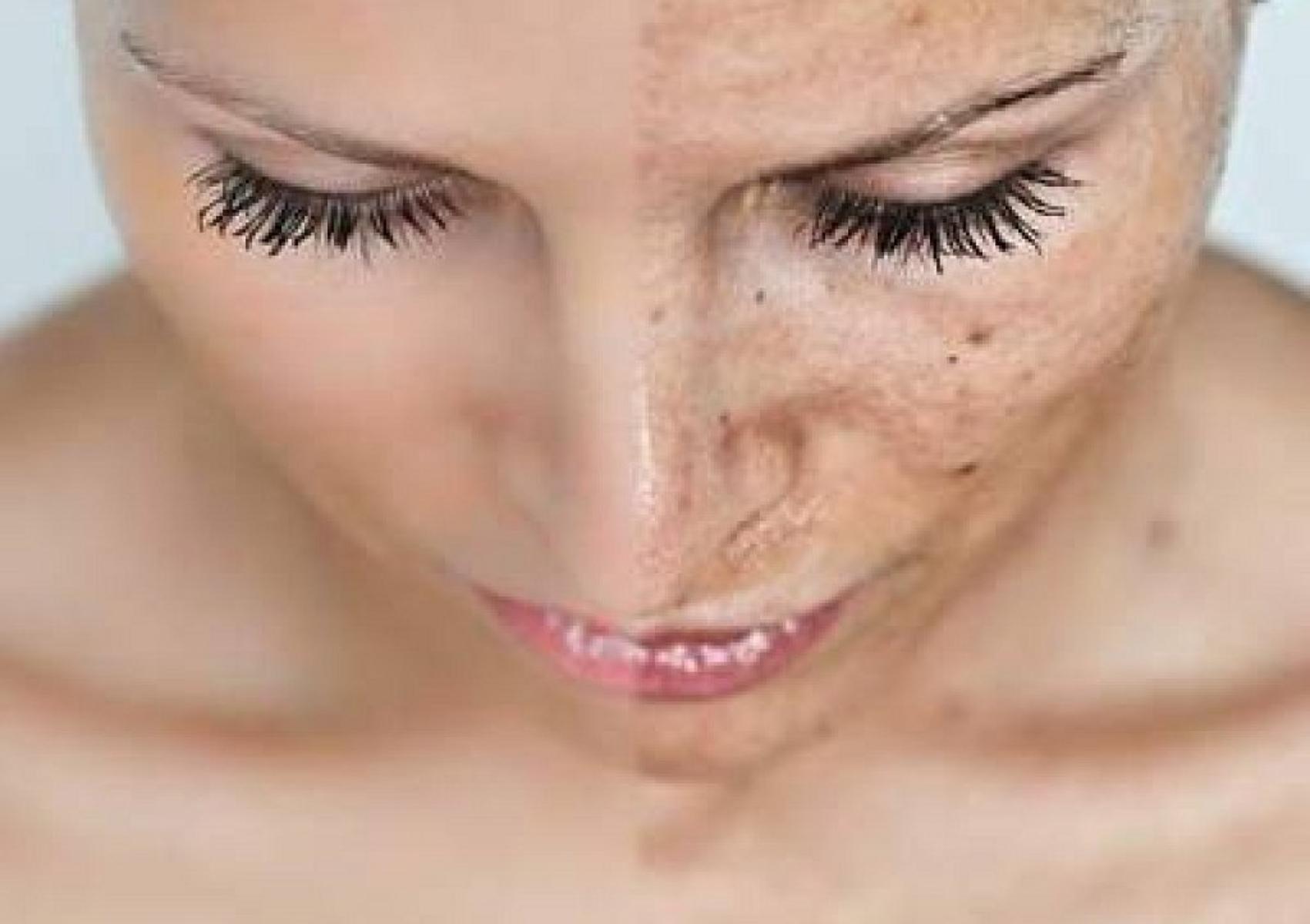 Πανάδες ή Κηλίδες από τον ήλιο: Γιατί εμφανίζονται και πώς θα τις αντιμετωπίσετε