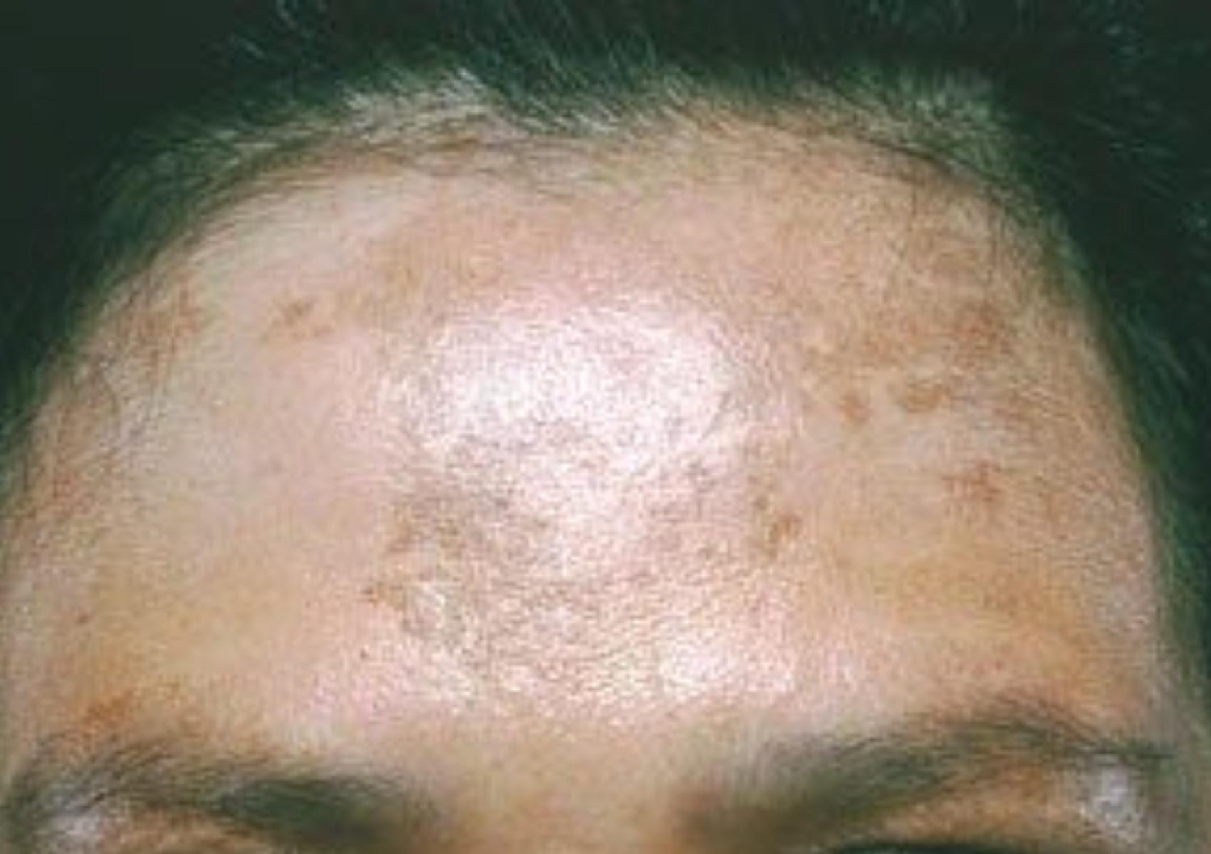 Πανάδες ή Κηλίδες από τον ήλιο: Γιατί εμφανίζονται και πώς θα τις αντιμετωπίσετε