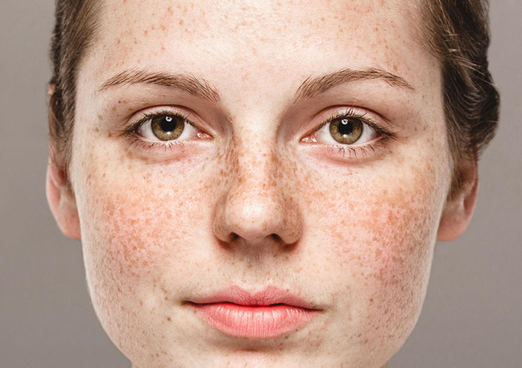 Πανάδες ή Κηλίδες από τον ήλιο: Γιατί εμφανίζονται και πώς θα τις αντιμετωπίσετε