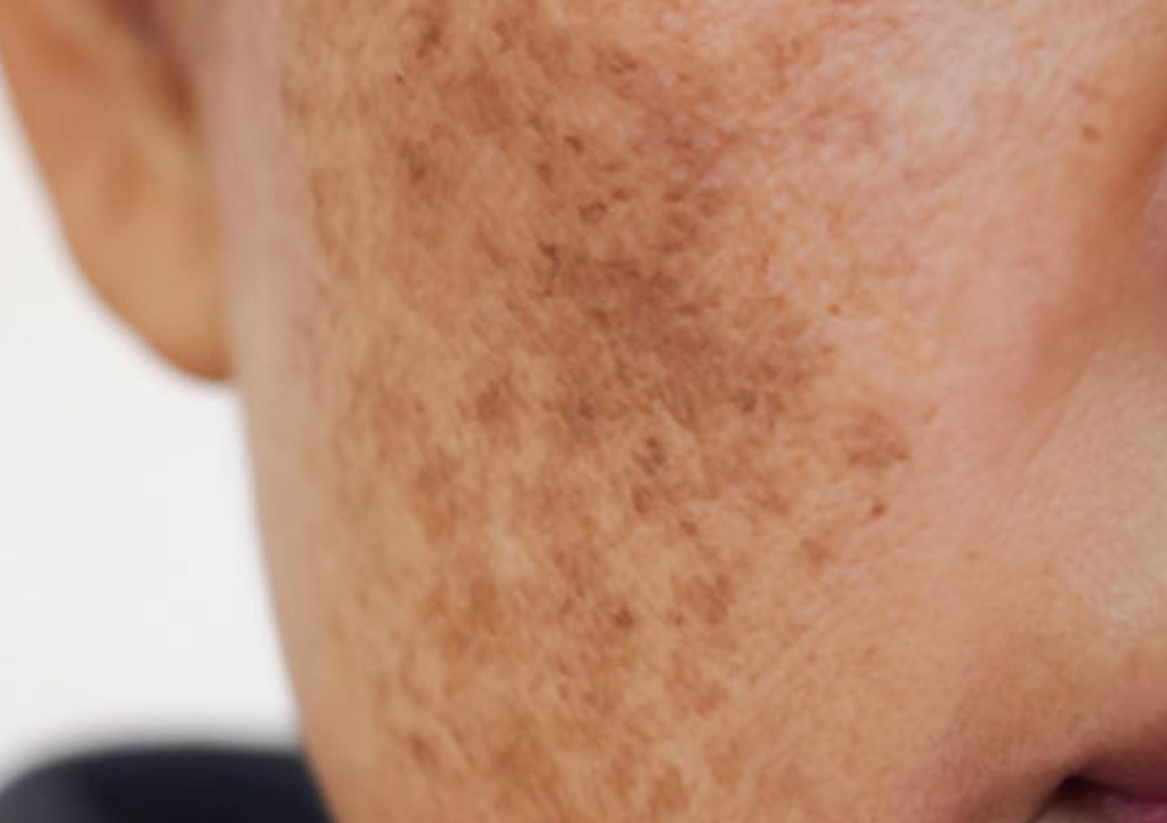 Πανάδες ή Κηλίδες από τον ήλιο: Γιατί εμφανίζονται και πώς θα τις αντιμετωπίσετε