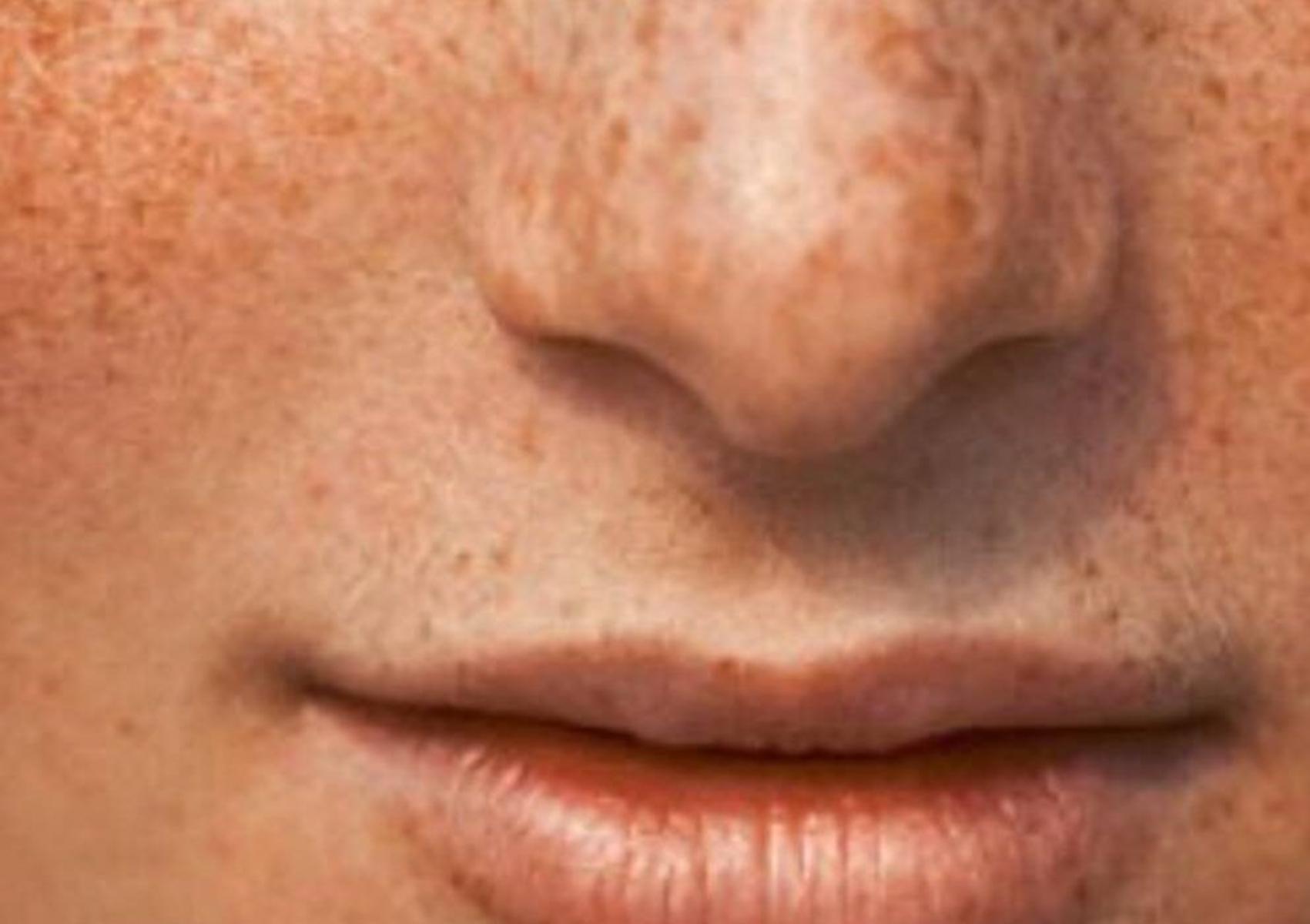 Πανάδες ή Κηλίδες από τον ήλιο: Γιατί εμφανίζονται και πώς θα τις αντιμετωπίσετε