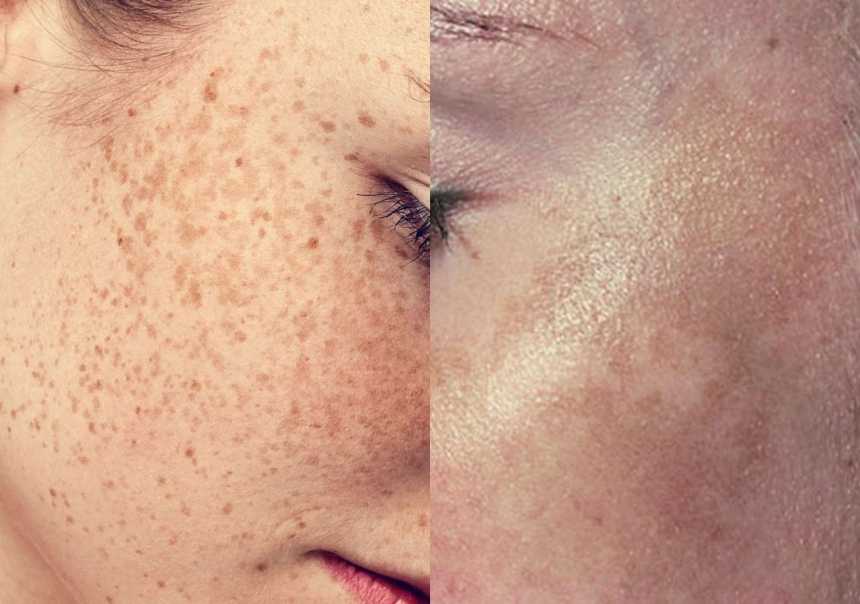 Πανάδες ή Κηλίδες από τον ήλιο: Γιατί εμφανίζονται και πώς θα τις αντιμετωπίσετε