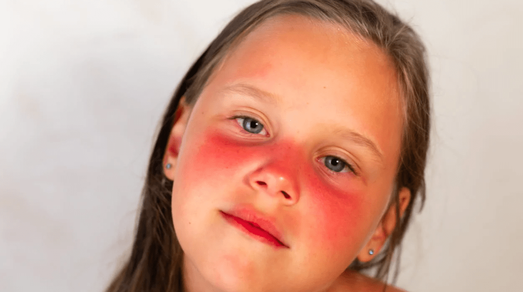 σπιτικό-σπρέι-για-το-έγκαυμα-από-τον-ήλιο-για-παιδιά-από-παιδίατρο- σπιτικό-σπρέι-για-το-έγκαυμα-από-τον-ήλιο-για-παιδιά-από-παιδίατρο-