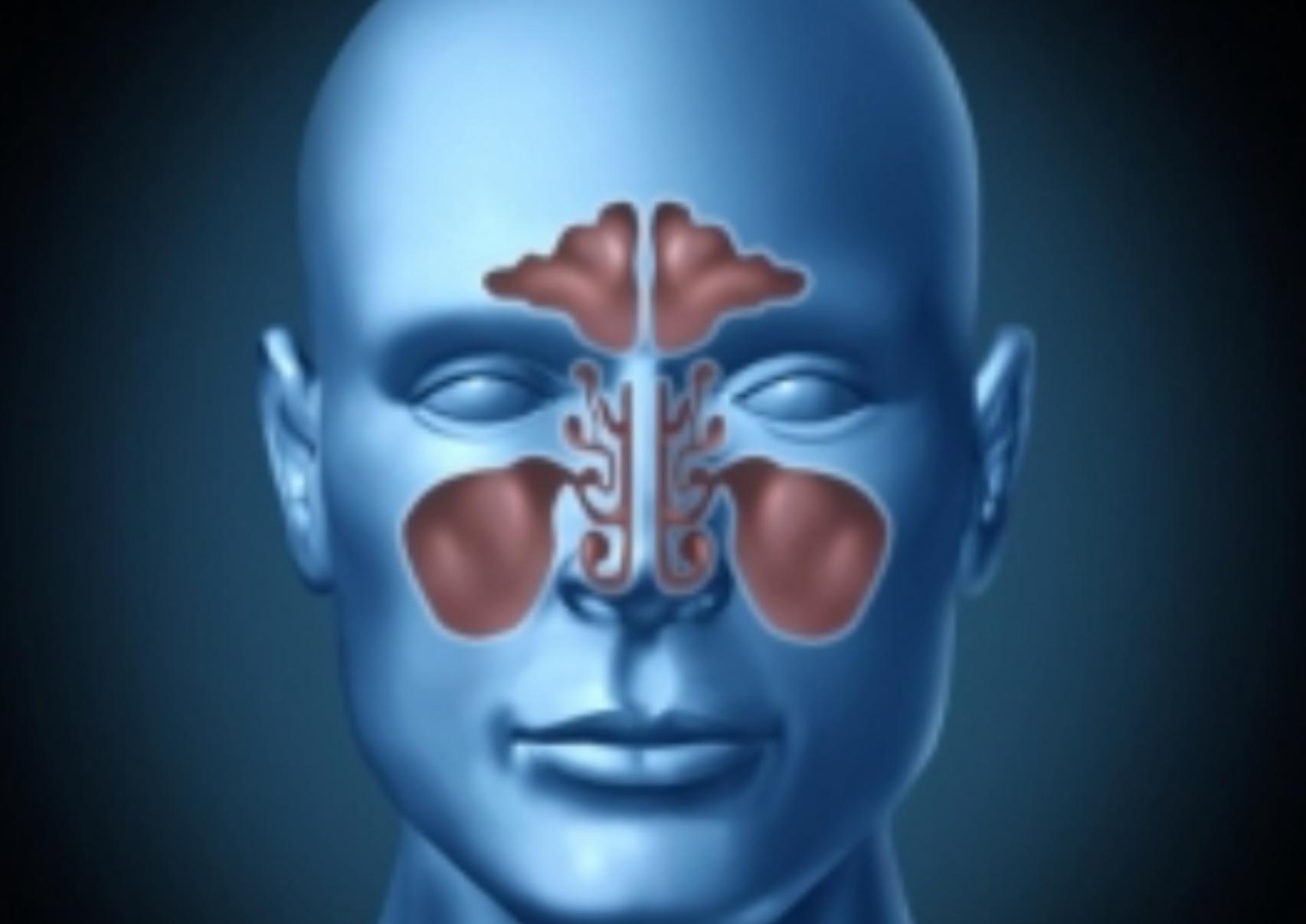 Ιγμορίτιδα: Ποια τα συμπτώματα ποια η θεραπεία και πως βοηθάει η θάλασσα