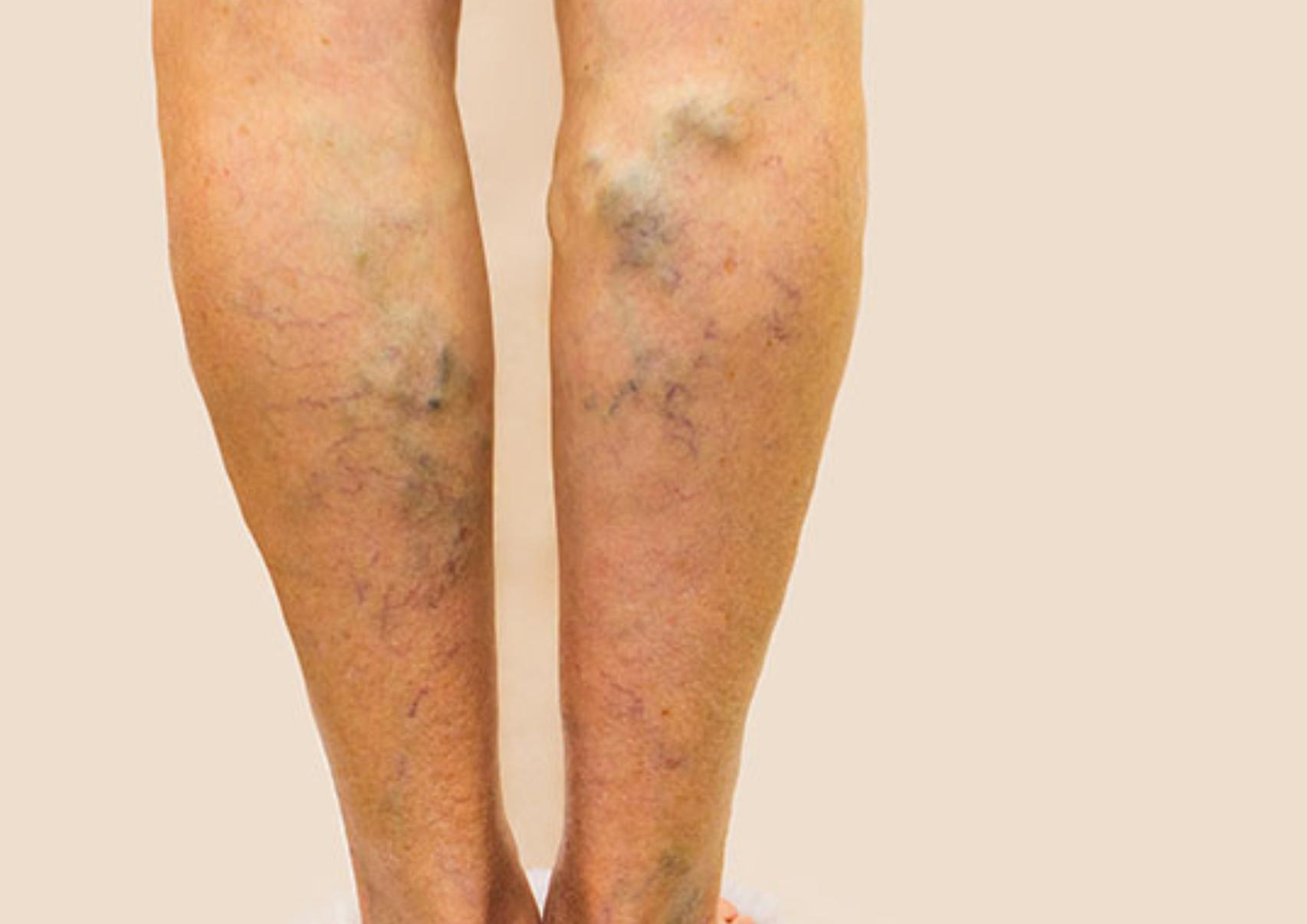 Κιρσοί: Ποια είναι τα αίτια που τους προκαλούν ποια τα συμπτώματα και ποια η θεραπεία