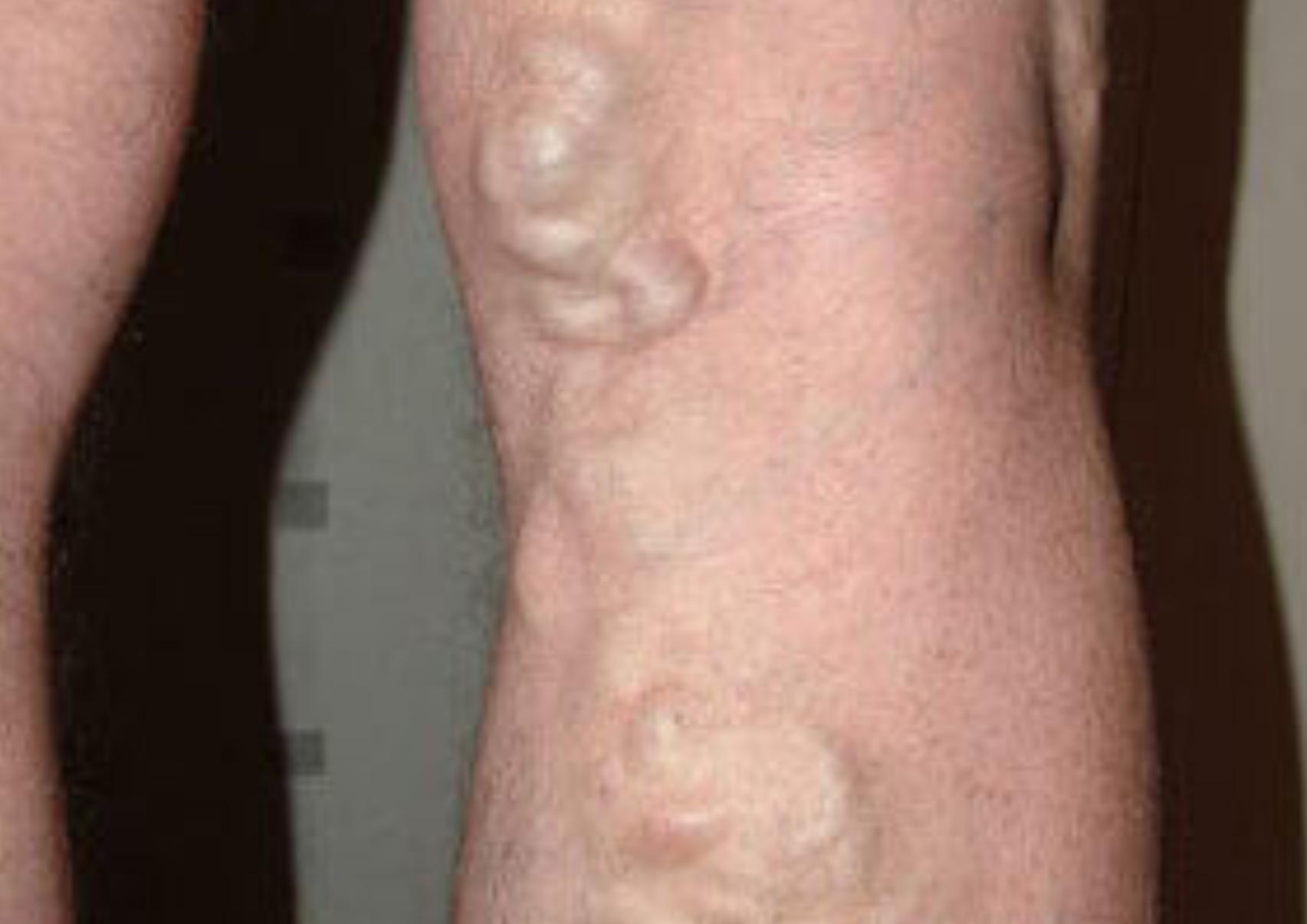 Κιρσοί: Ποια είναι τα αίτια που τους προκαλούν ποια τα συμπτώματα και ποια η θεραπεία