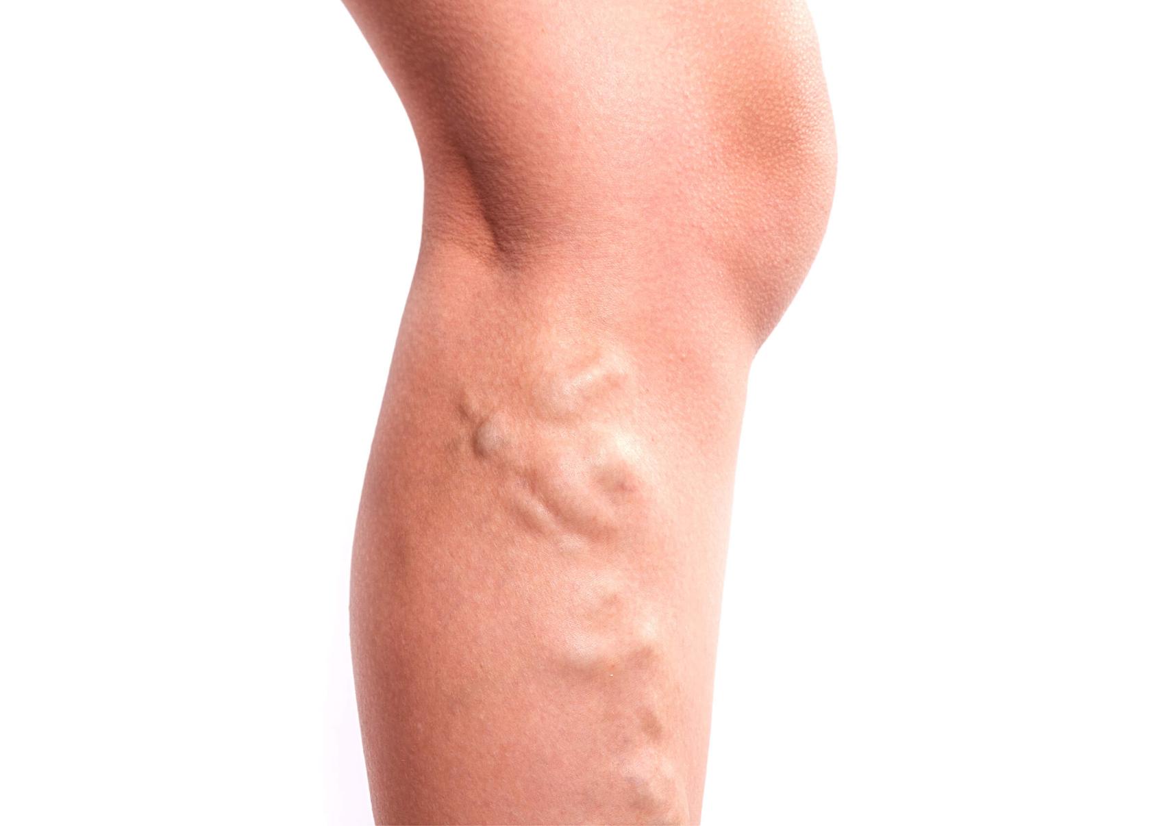 Κιρσοί: Ποια είναι τα αίτια που τους προκαλούν ποια τα συμπτώματα και ποια η θεραπεία