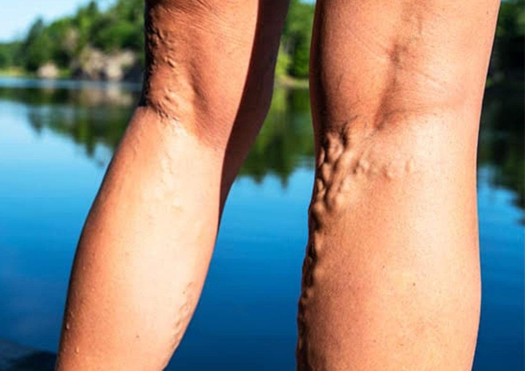 Κιρσοί: Ποια είναι τα αίτια που τους προκαλούν ποια τα συμπτώματα και ποια η θεραπεία