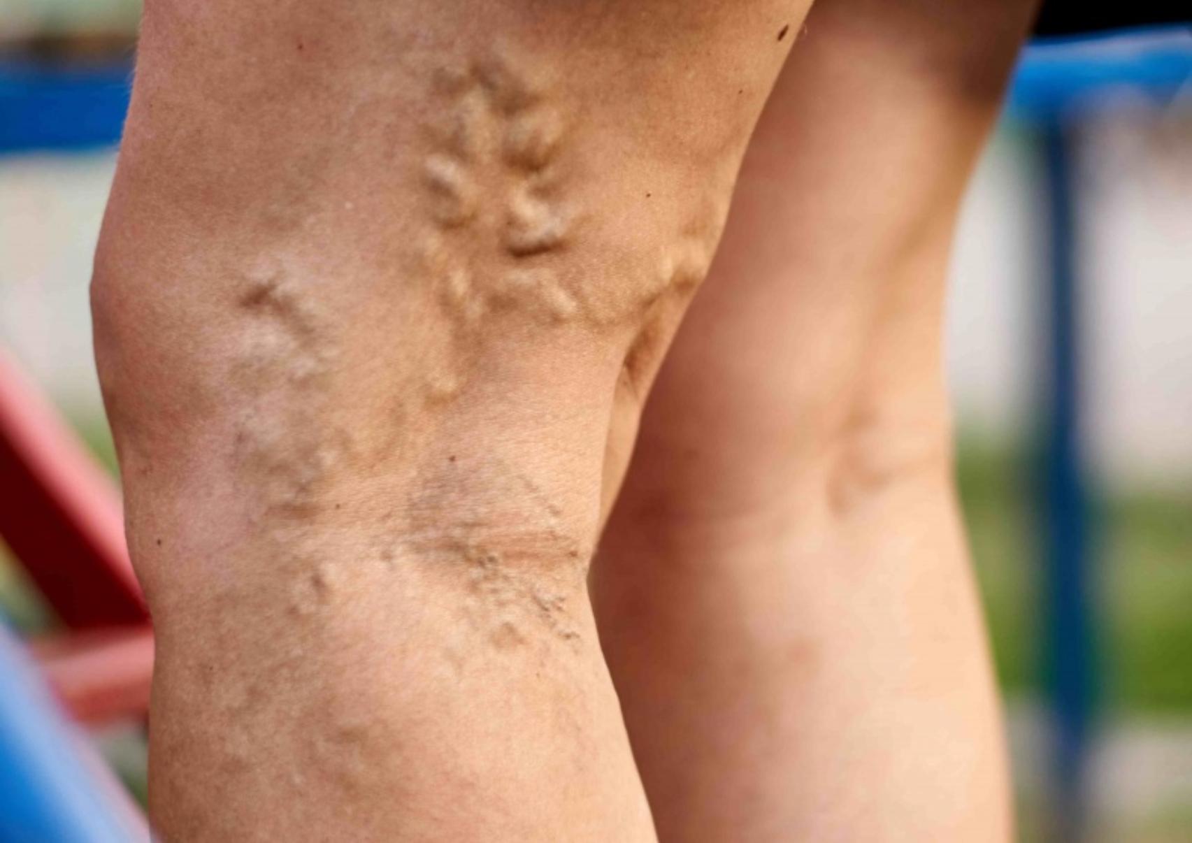 Κιρσοί: Ποια είναι τα αίτια που τους προκαλούν ποια τα συμπτώματα και ποια η θεραπεία