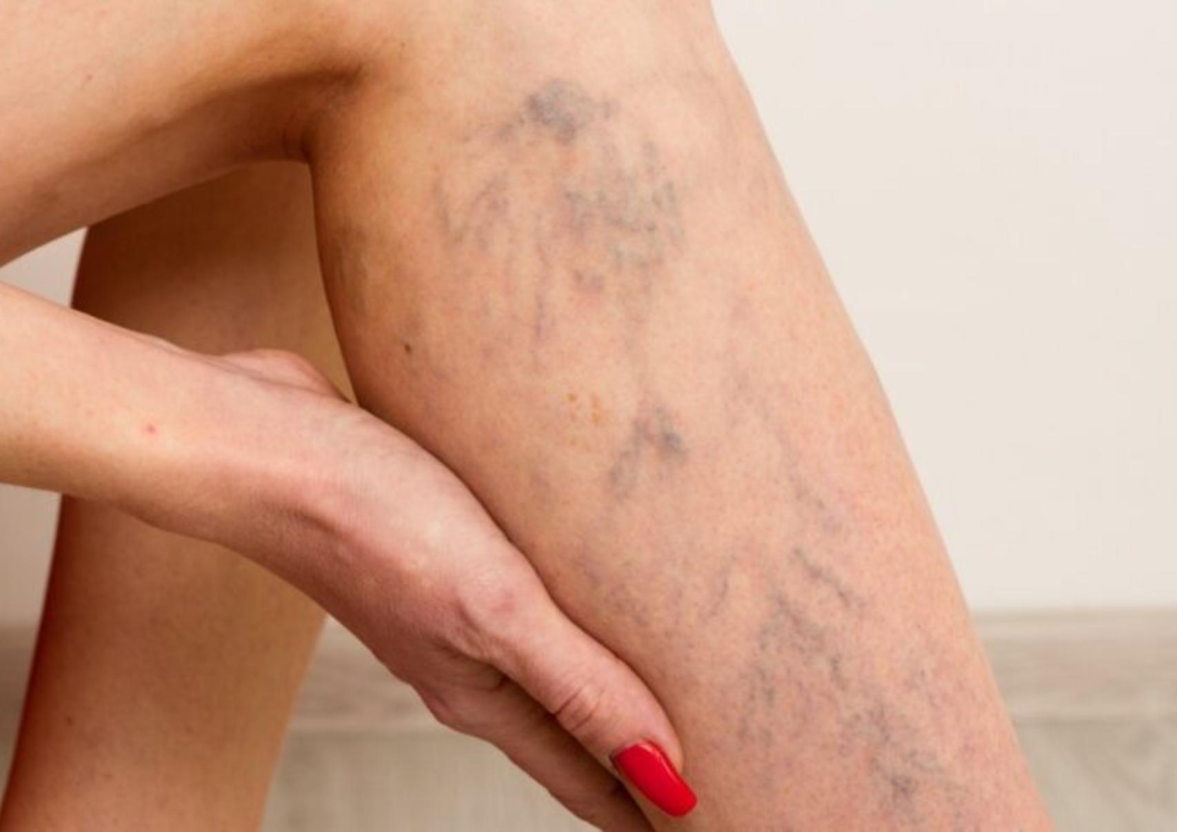 Κιρσοί: Ποια είναι τα αίτια που τους προκαλούν ποια τα συμπτώματα και ποια η θεραπεία