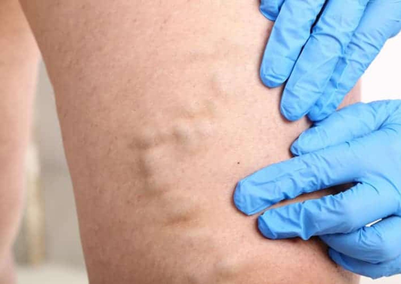 Κιρσοί: Ποια είναι τα αίτια που τους προκαλούν ποια τα συμπτώματα και ποια η θεραπεία