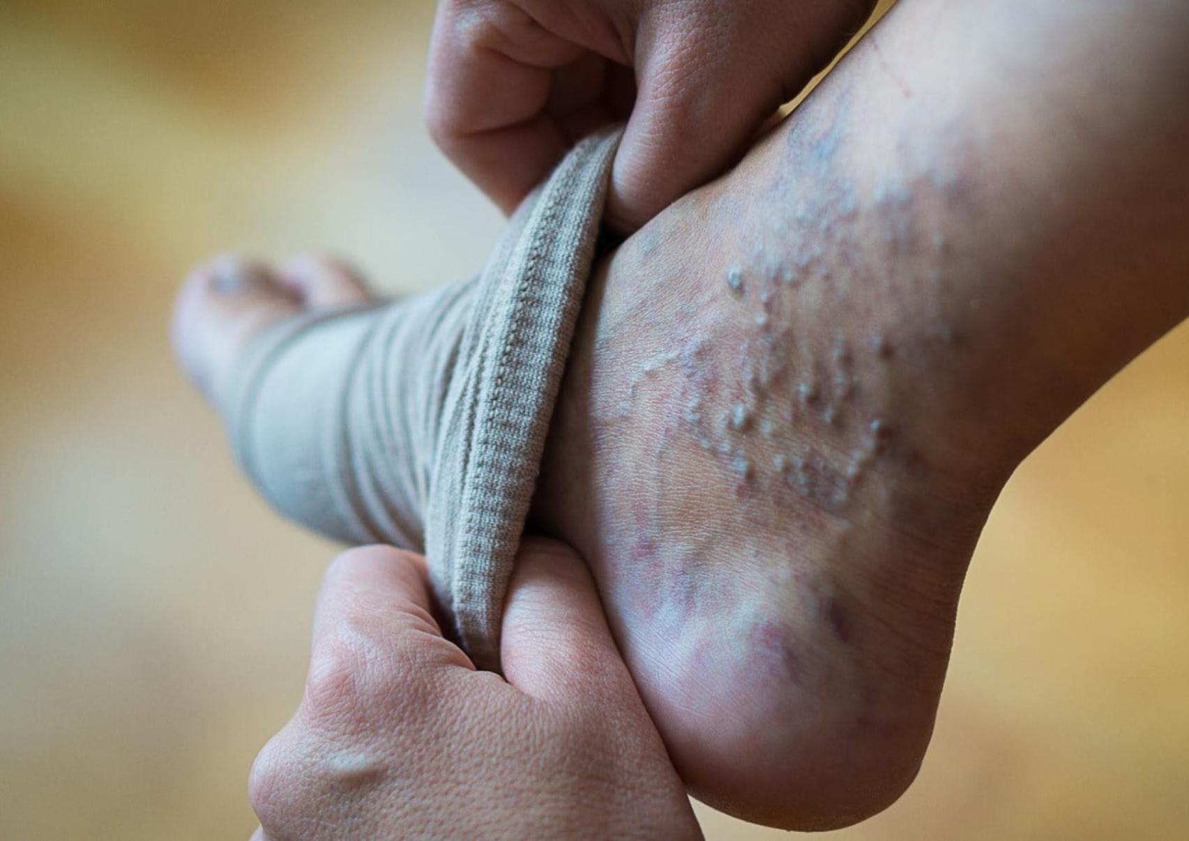 Κιρσοί: Ποια είναι τα αίτια που τους προκαλούν ποια τα συμπτώματα και ποια η θεραπεία