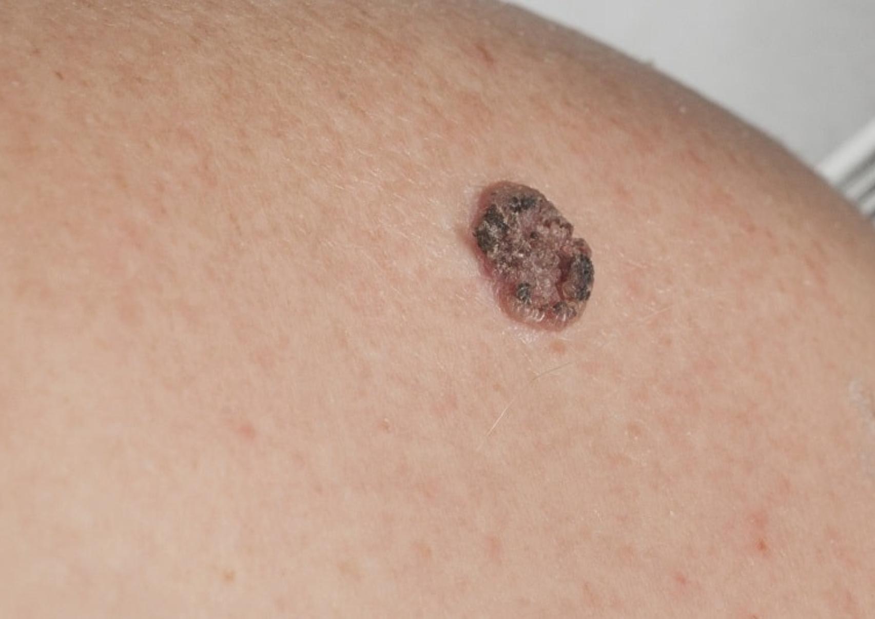 Μελάνωμα: Τι είναι ποια τα αίτια και πόσο επηρεάζει η έκθεση μας στον ήλιο