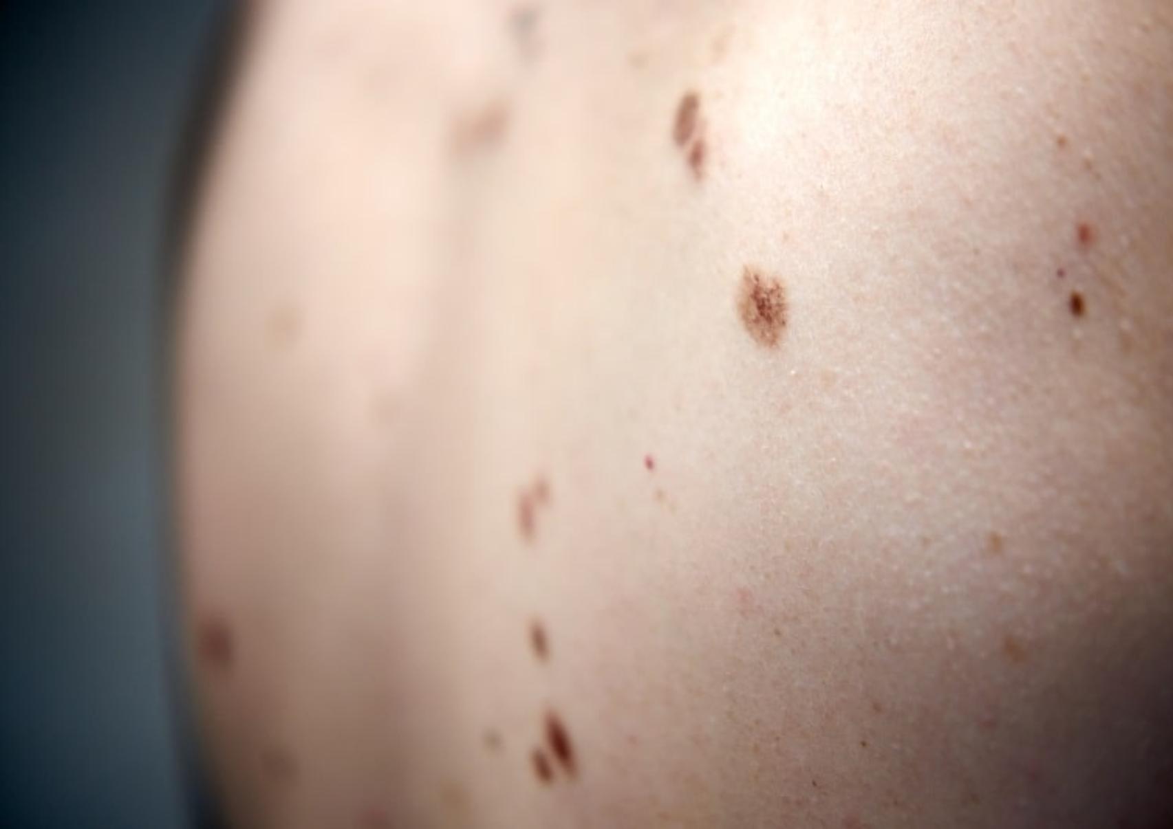 Μελάνωμα: Τι είναι ποια τα αίτια και πόσο επηρεάζει η έκθεση μας στον ήλιο