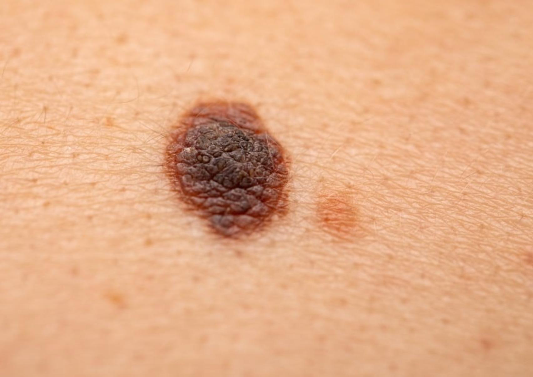 Μελάνωμα: Τι είναι ποια τα αίτια και πόσο επηρεάζει η έκθεση μας στον ήλιο