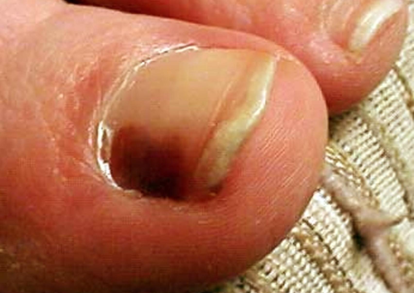 Μελάνωμα: Τι είναι ποια τα αίτια και πόσο επηρεάζει η έκθεση μας στον ήλιο