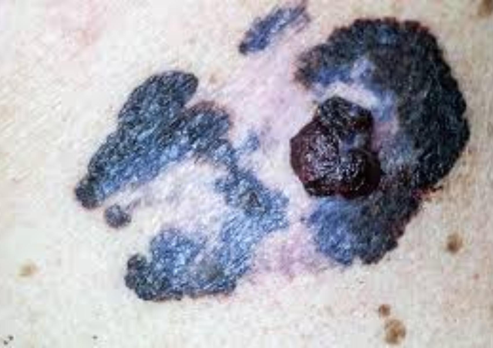 Μελάνωμα: Τι είναι ποια τα αίτια και πόσο επηρεάζει η έκθεση μας στον ήλιο