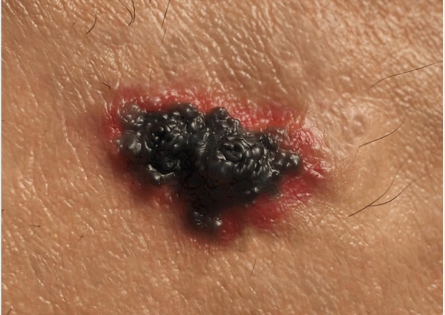 Μελάνωμα: Τι είναι ποια τα αίτια και πόσο επηρεάζει η έκθεση μας στον ήλιο