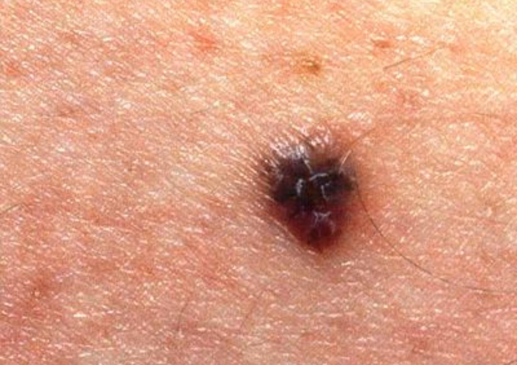 Μελάνωμα: Τι είναι ποια τα αίτια και πόσο επηρεάζει η έκθεση μας στον ήλιο